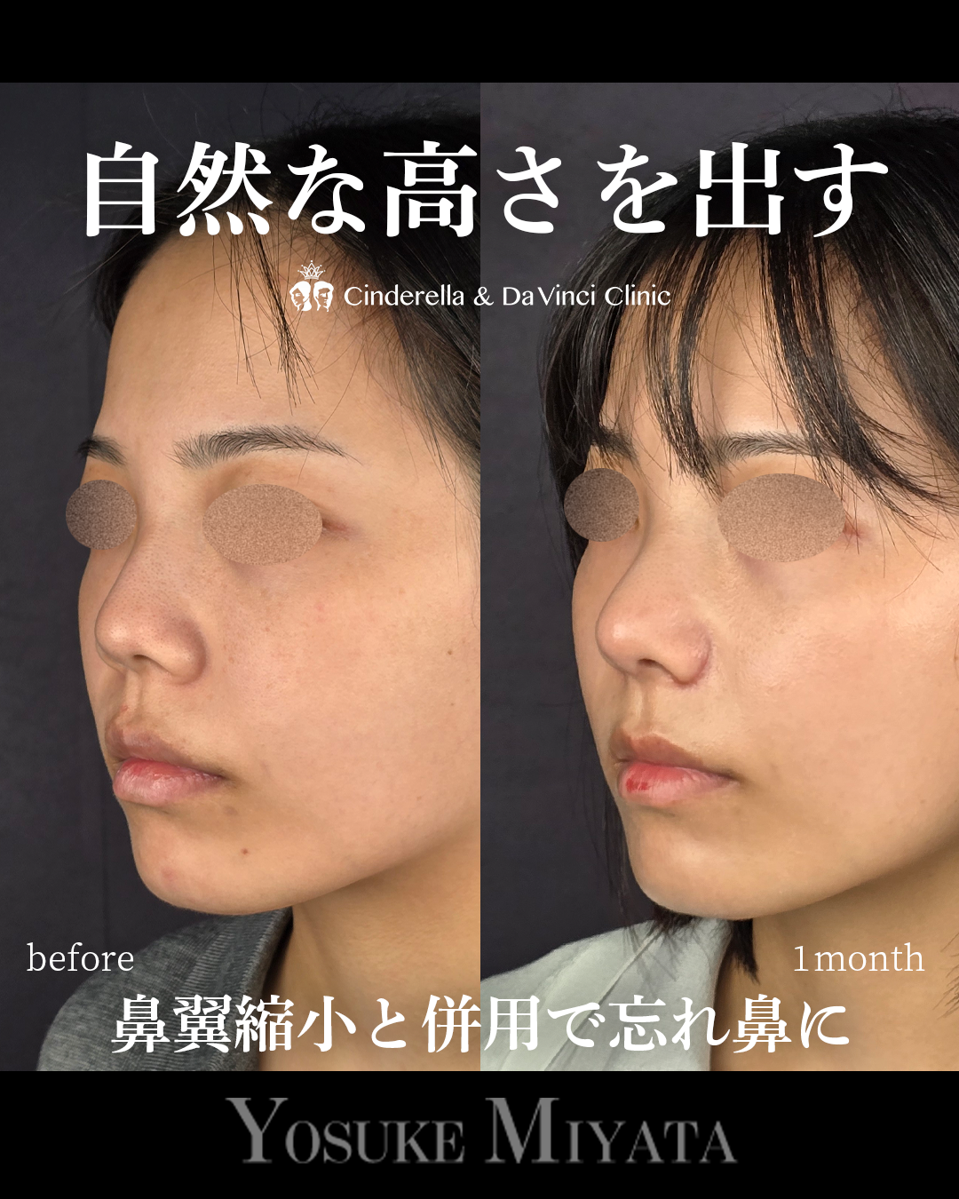 自然な高さを出す鼻整形の画像