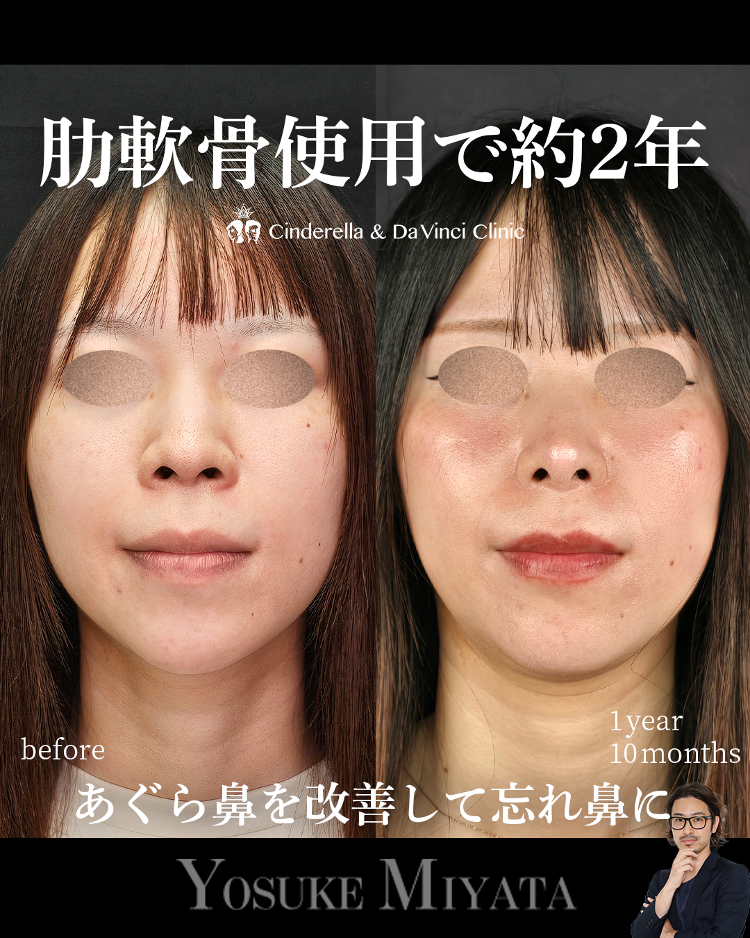 肋軟骨使用の鼻整形で2年経過の画像