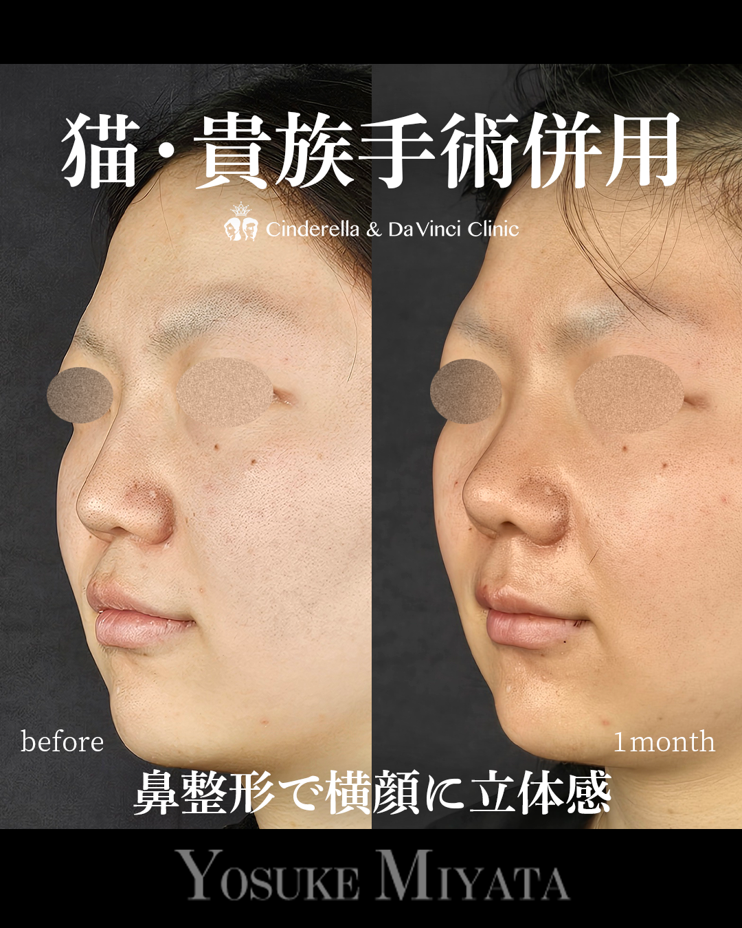 横顔に立体感を出すの画像