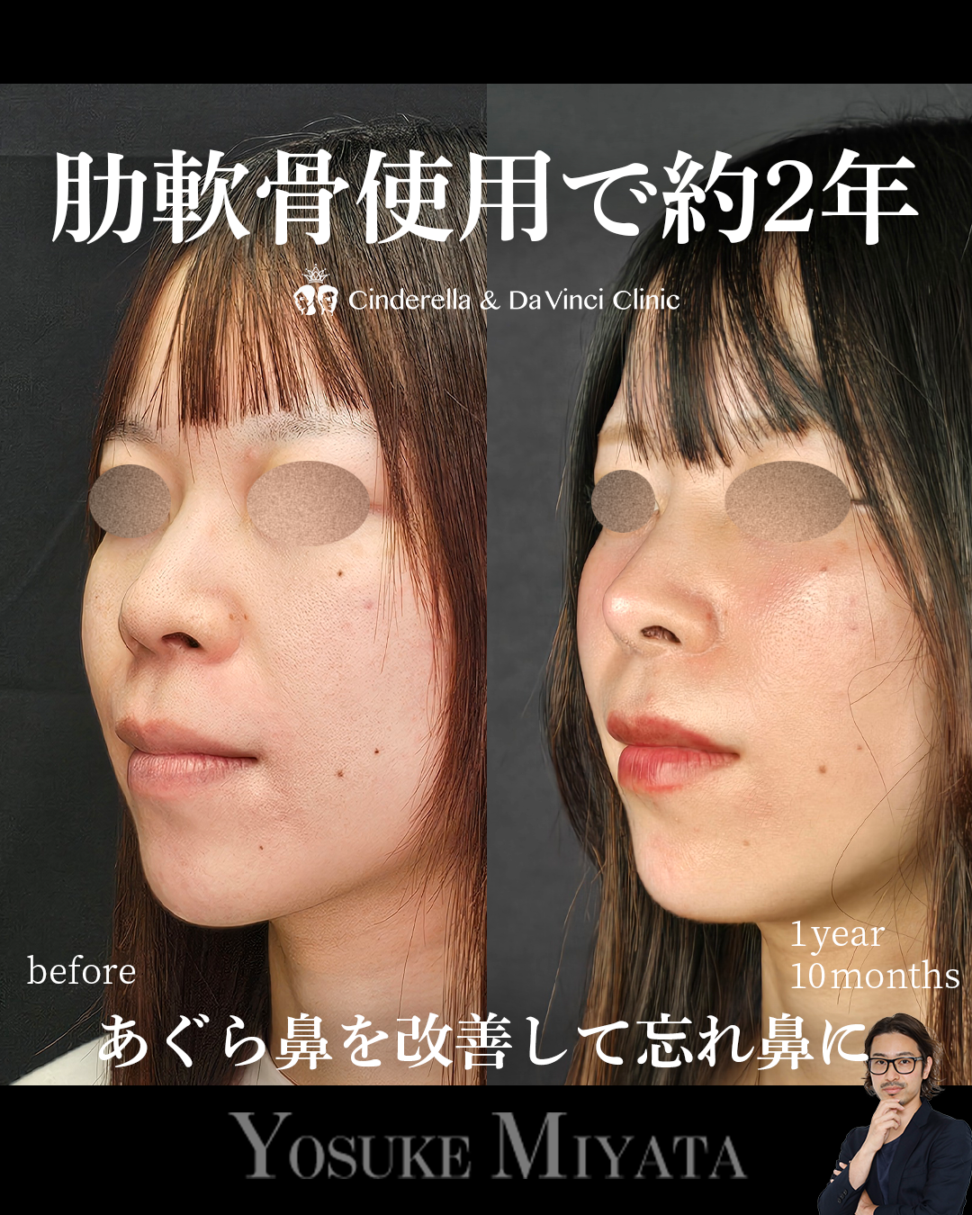 肋軟骨使用の鼻整形で2年経過の画像