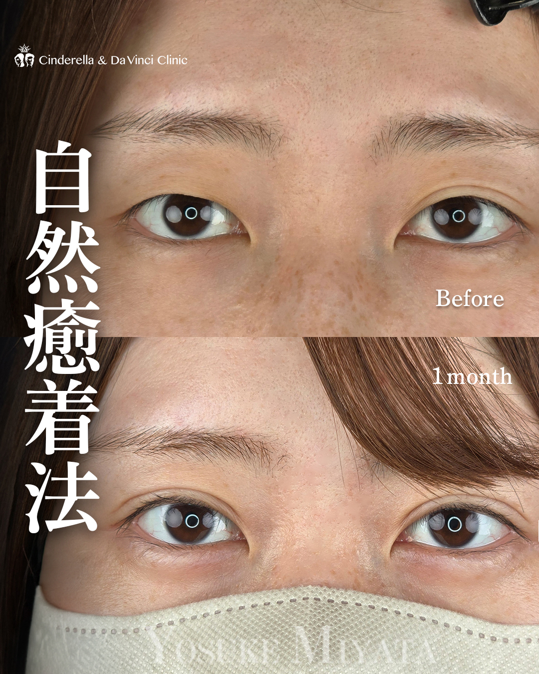 左右差のない二重ライン