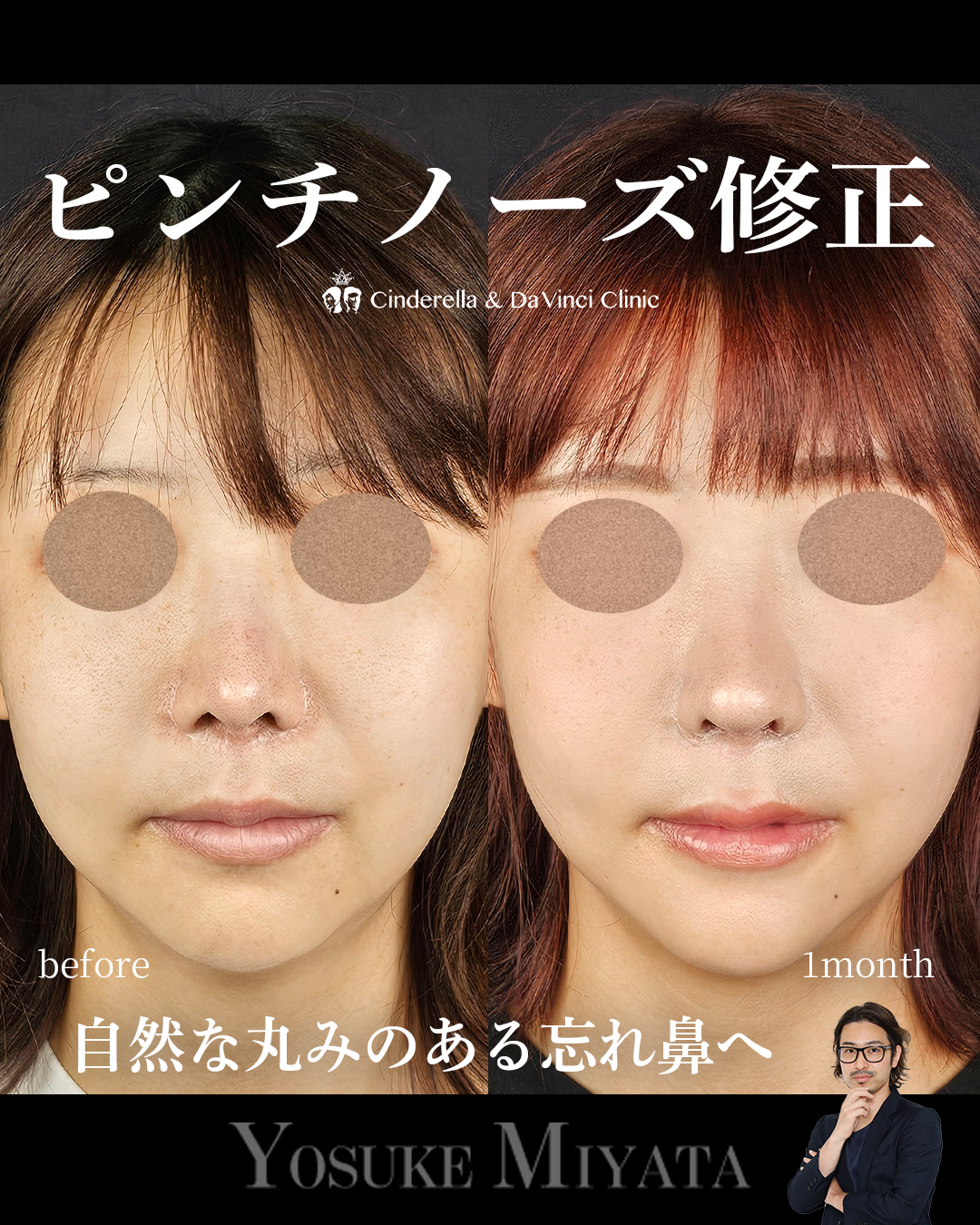 ピンチノーズ修正