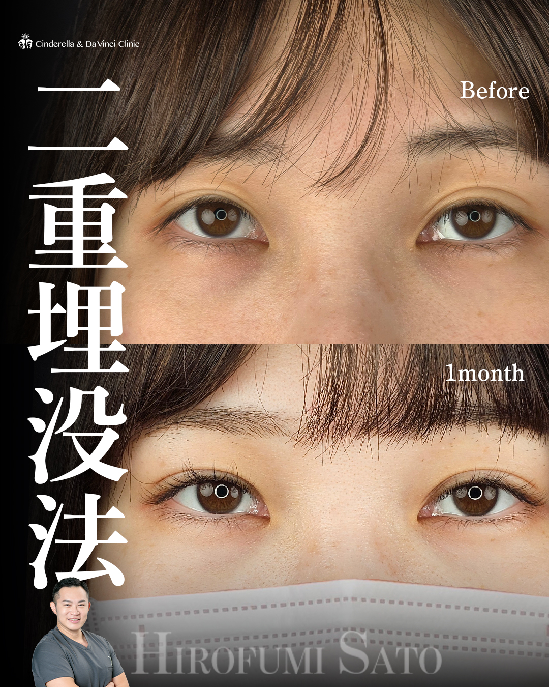 自然な二重