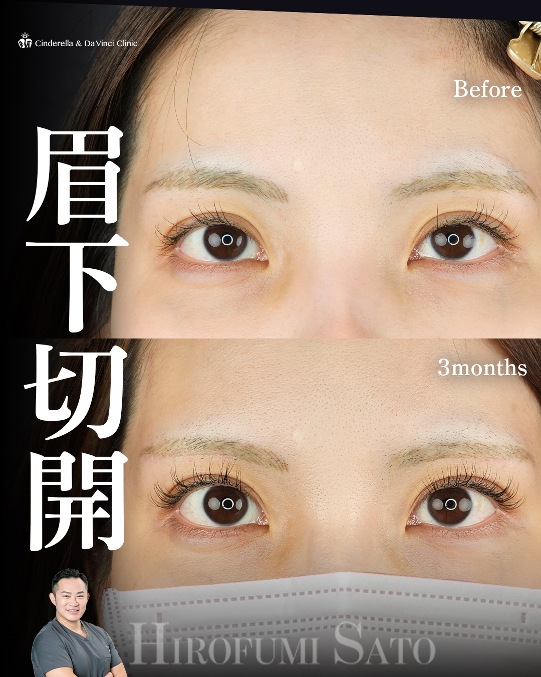 眉下切開