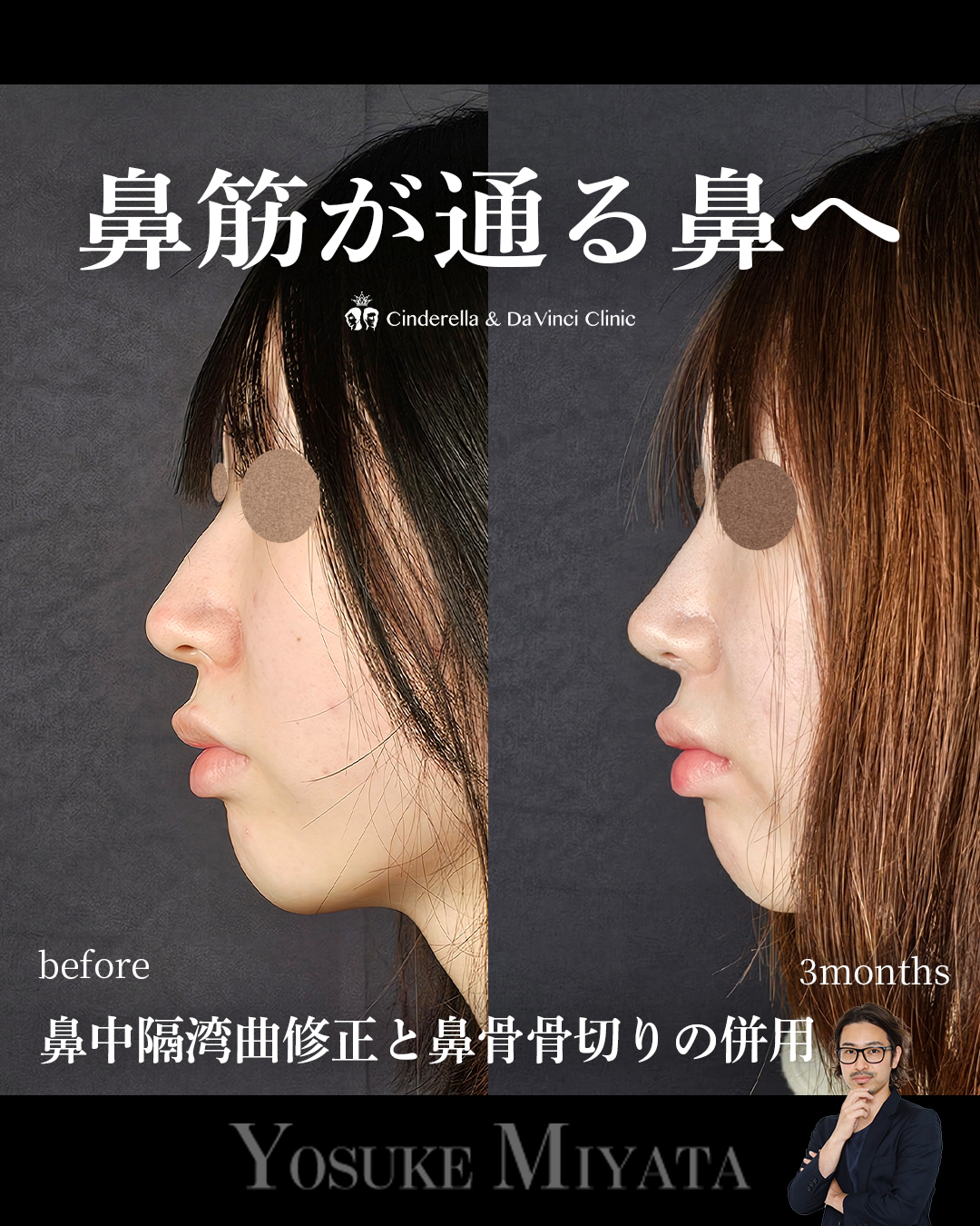 鼻筋が通る鼻への画像