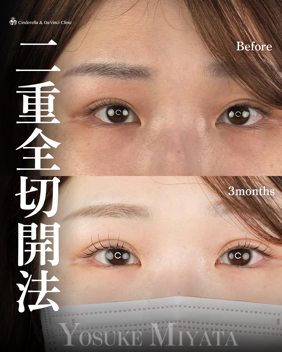 二重全切開