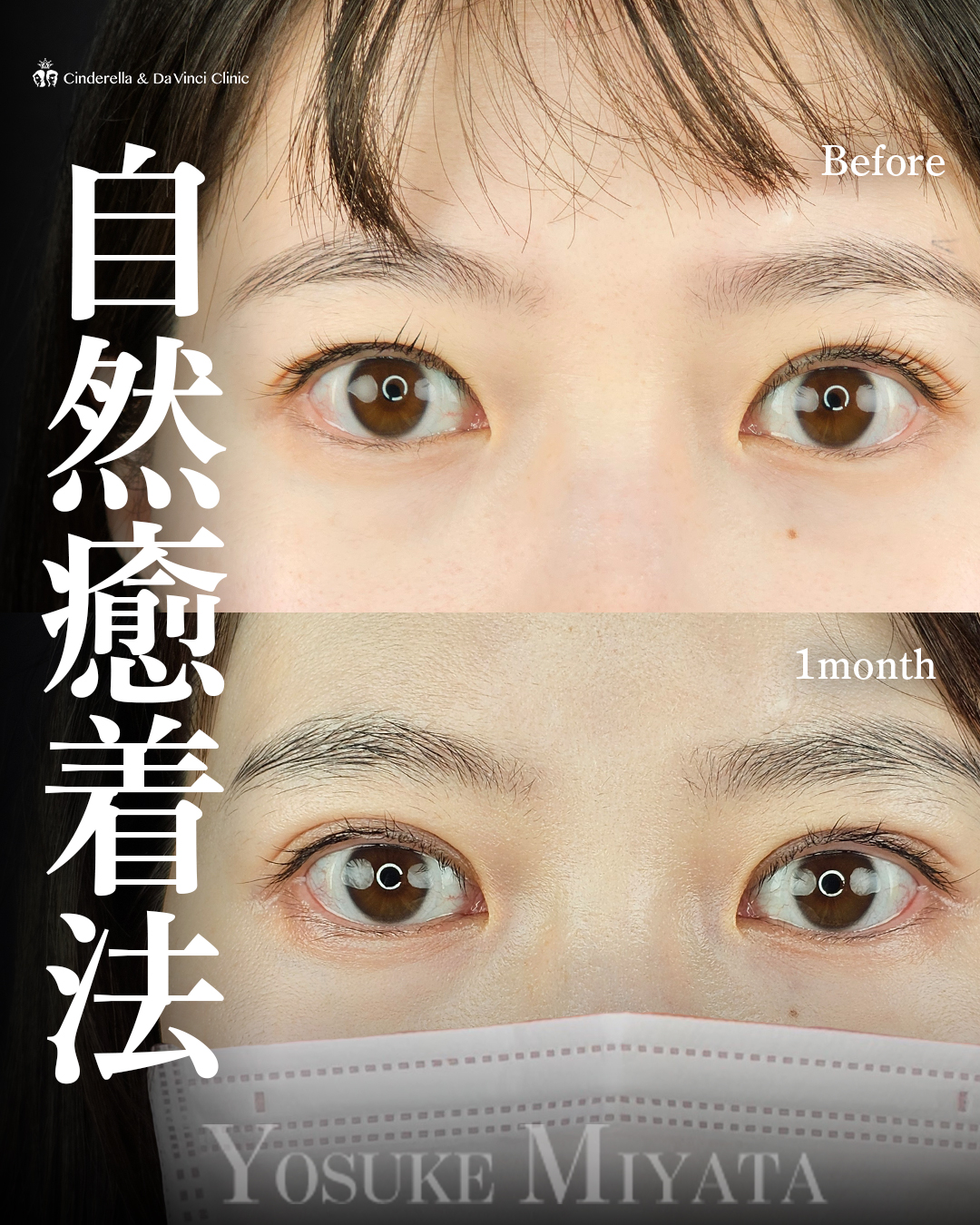ナチュ盛り二重