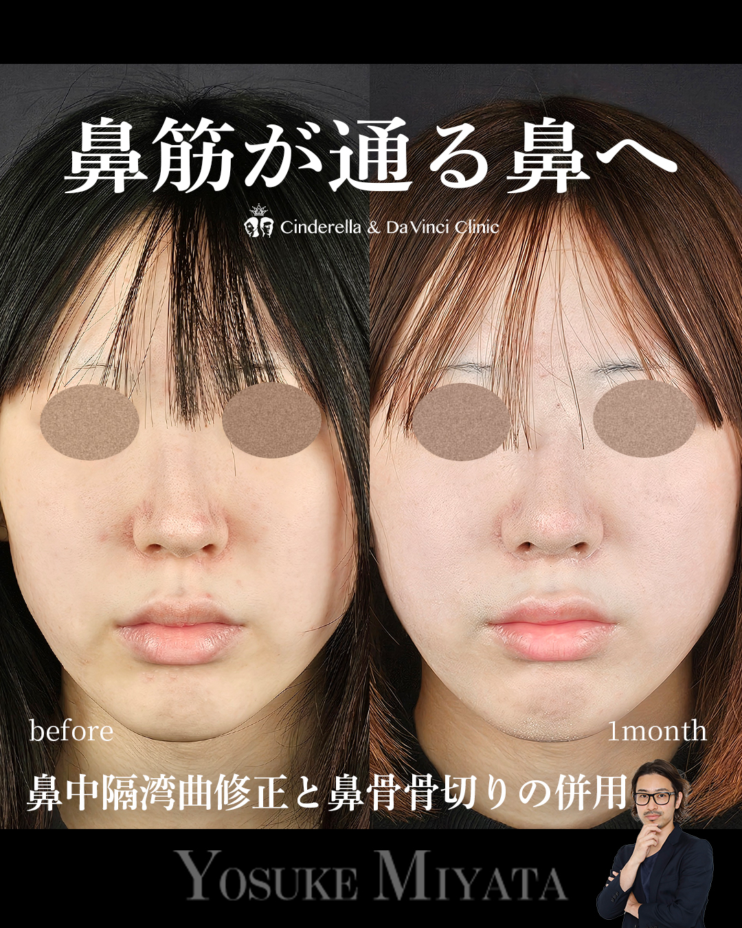 鼻筋が通る鼻へ