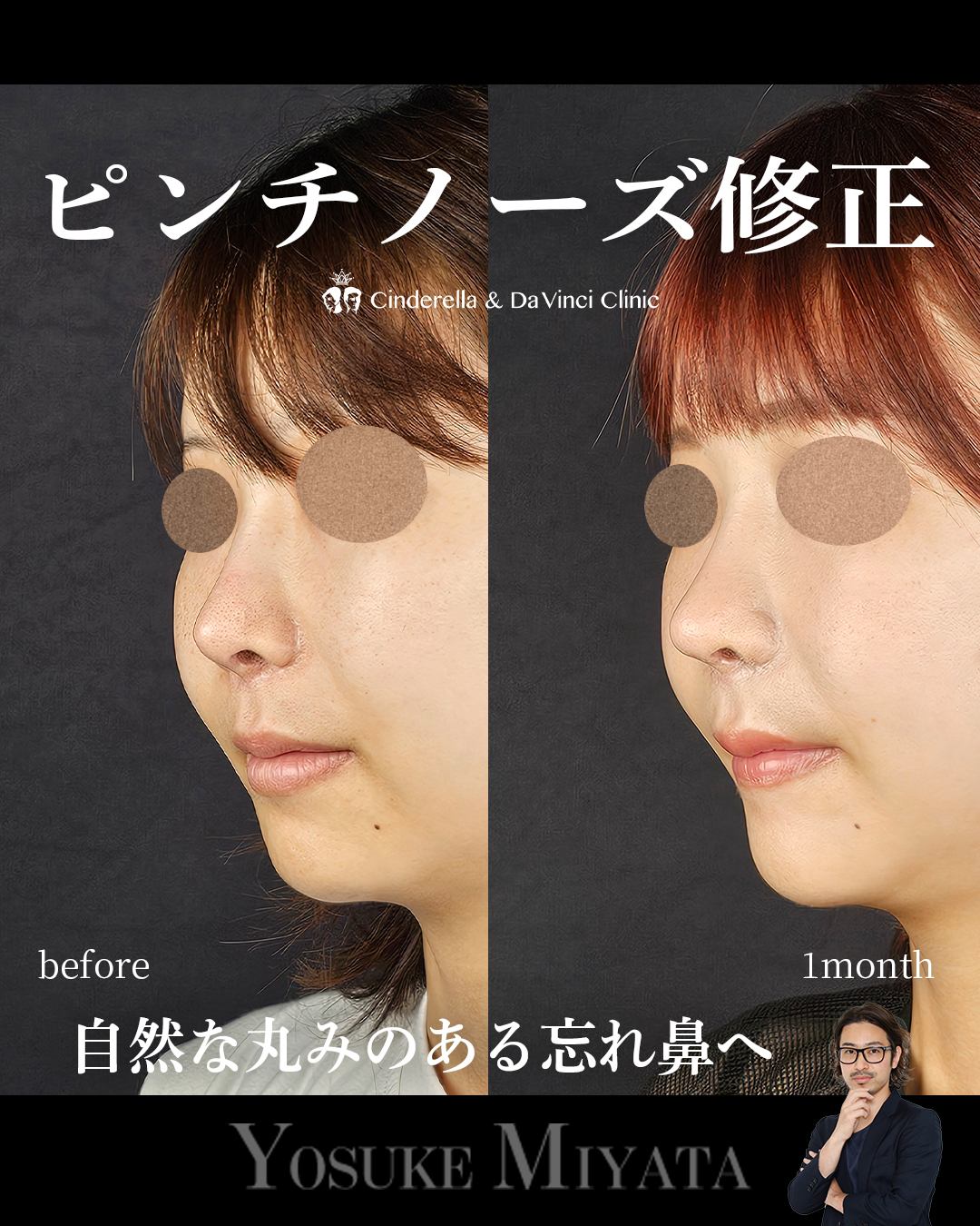 ピンチノーズ修正の画像