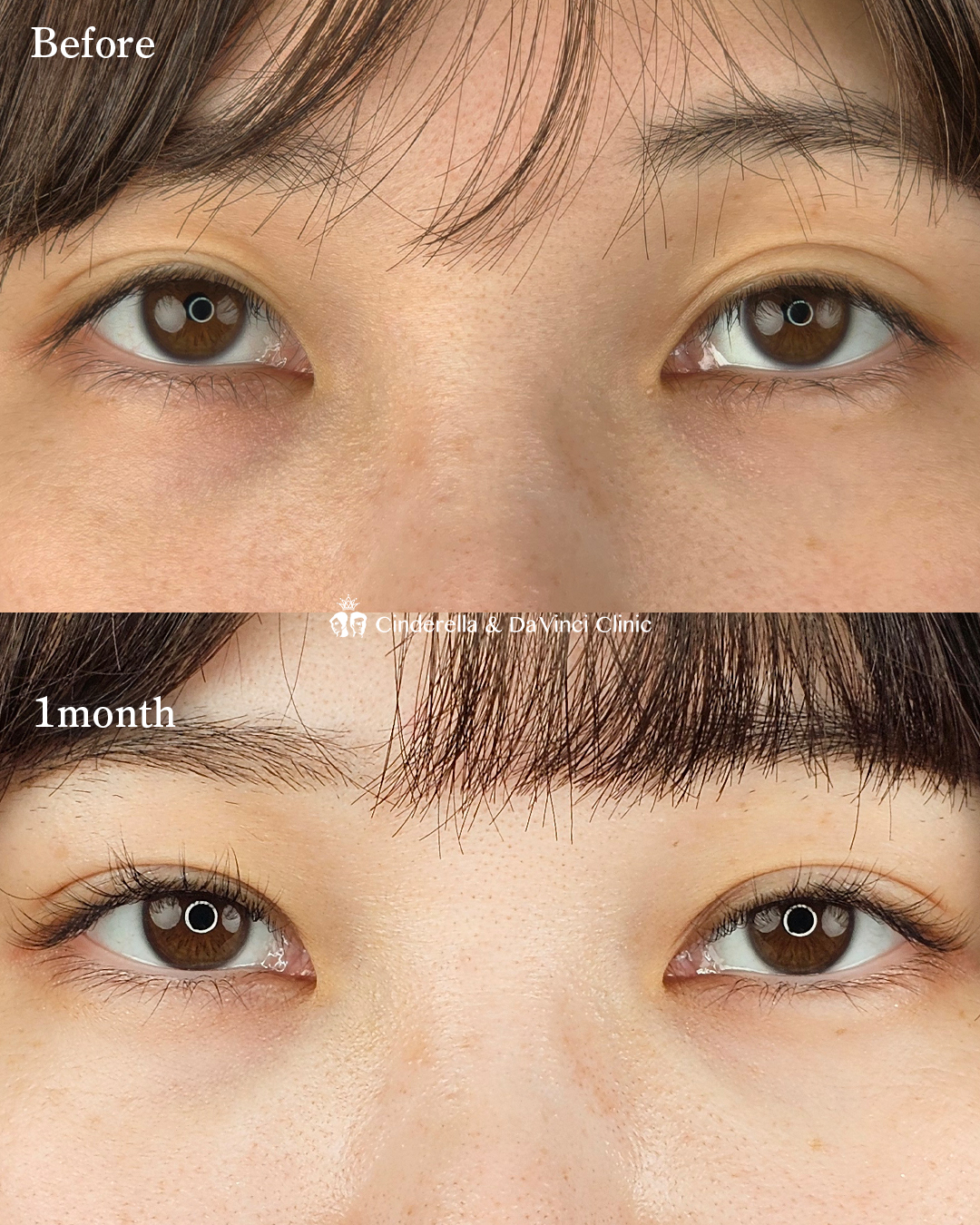 自然な二重の画像