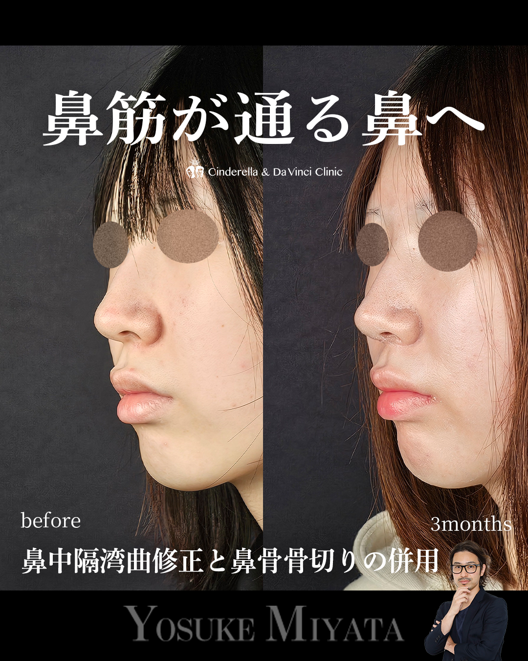 鼻筋が通る鼻への画像