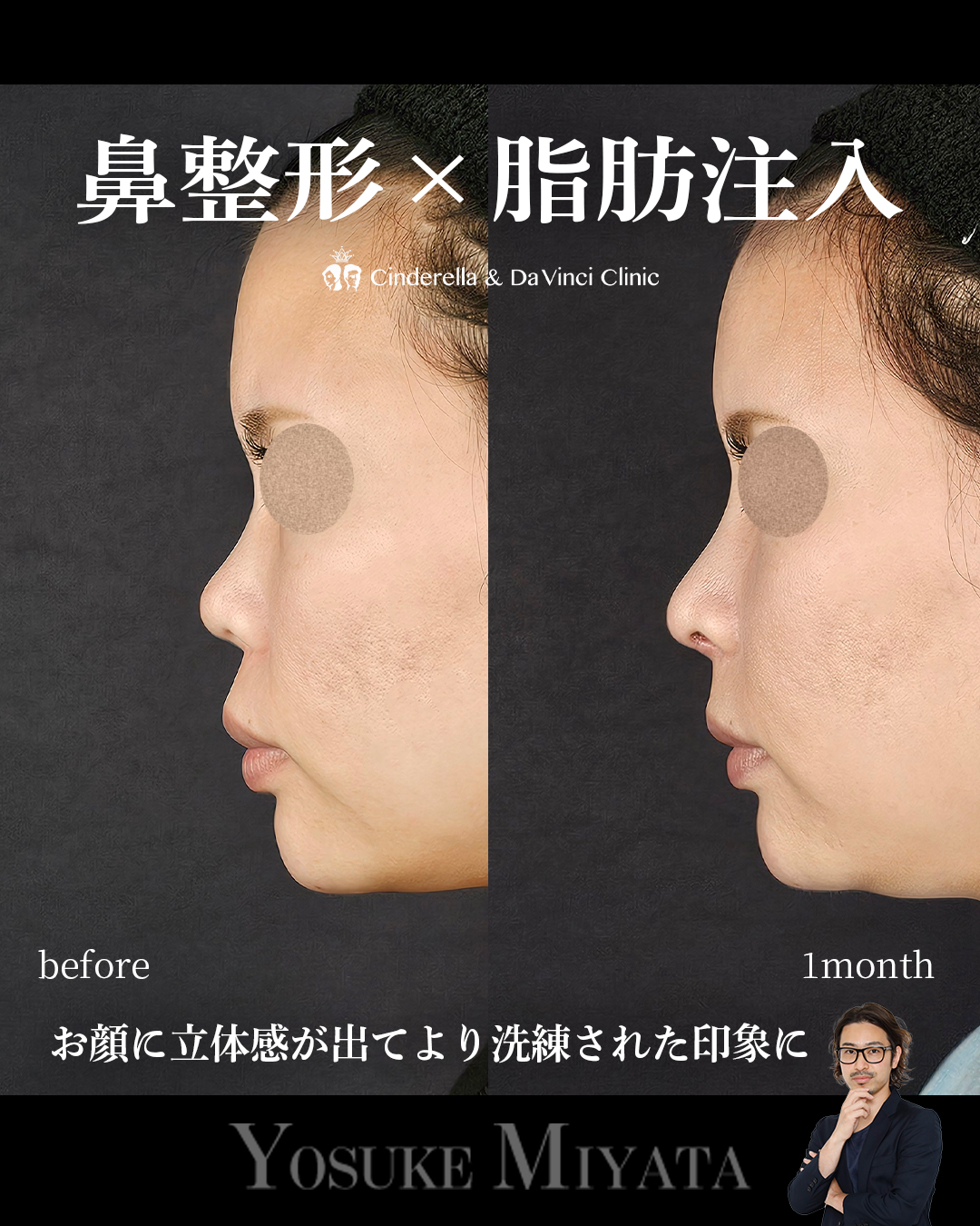 鼻整形×脂肪注入の画像