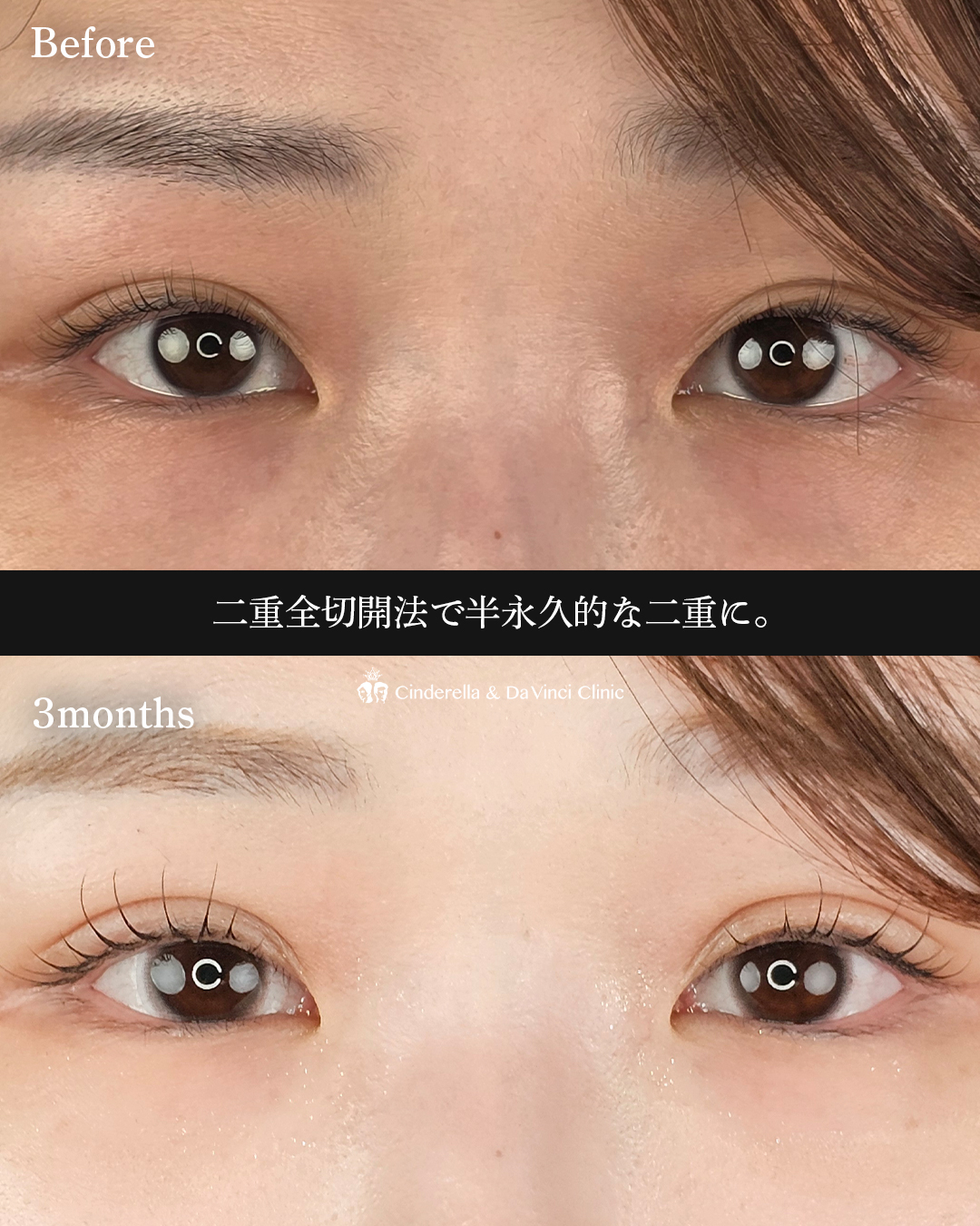 二重全切開の画像