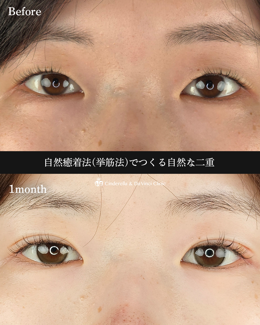 自然な二重の画像