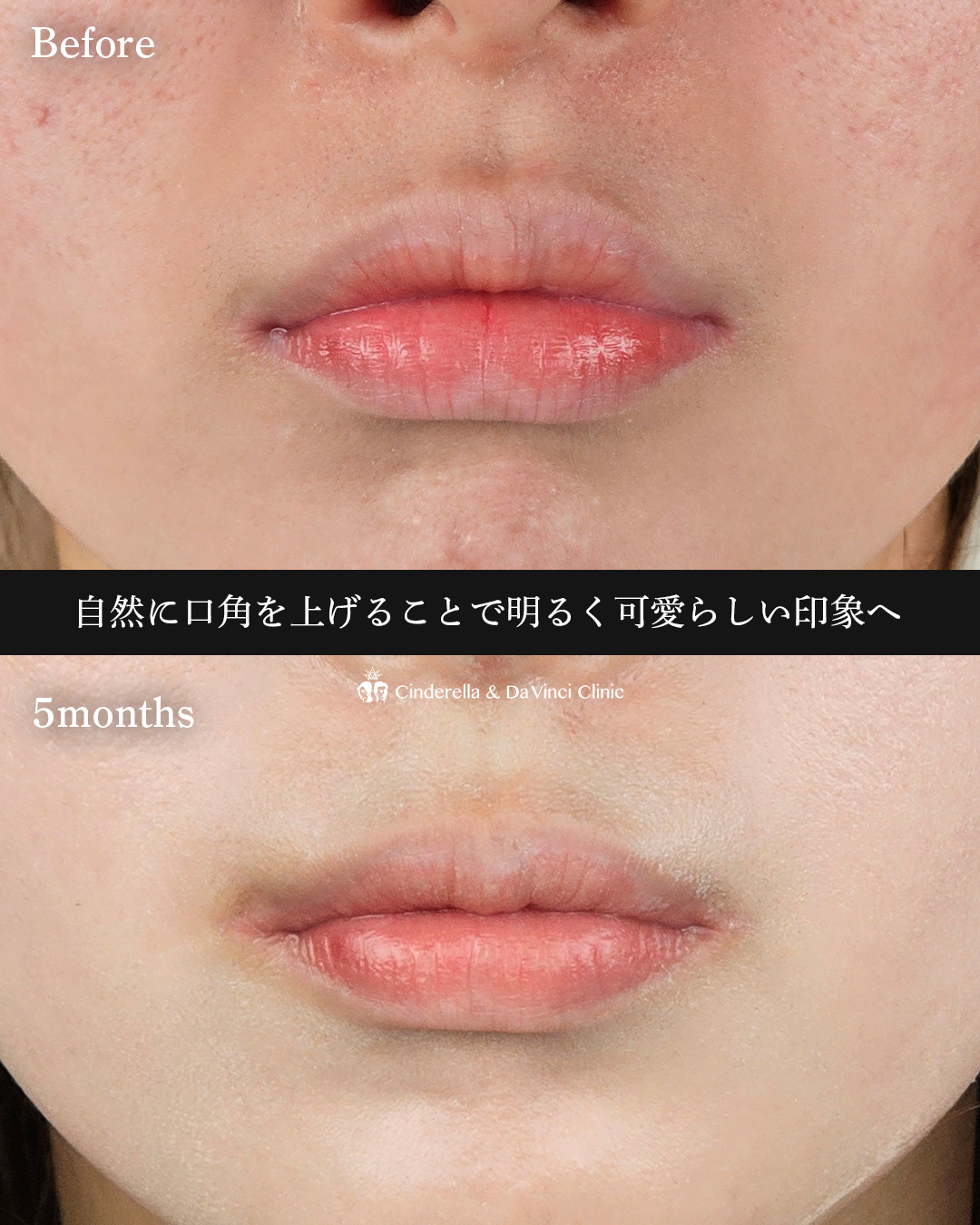口角挙上の画像