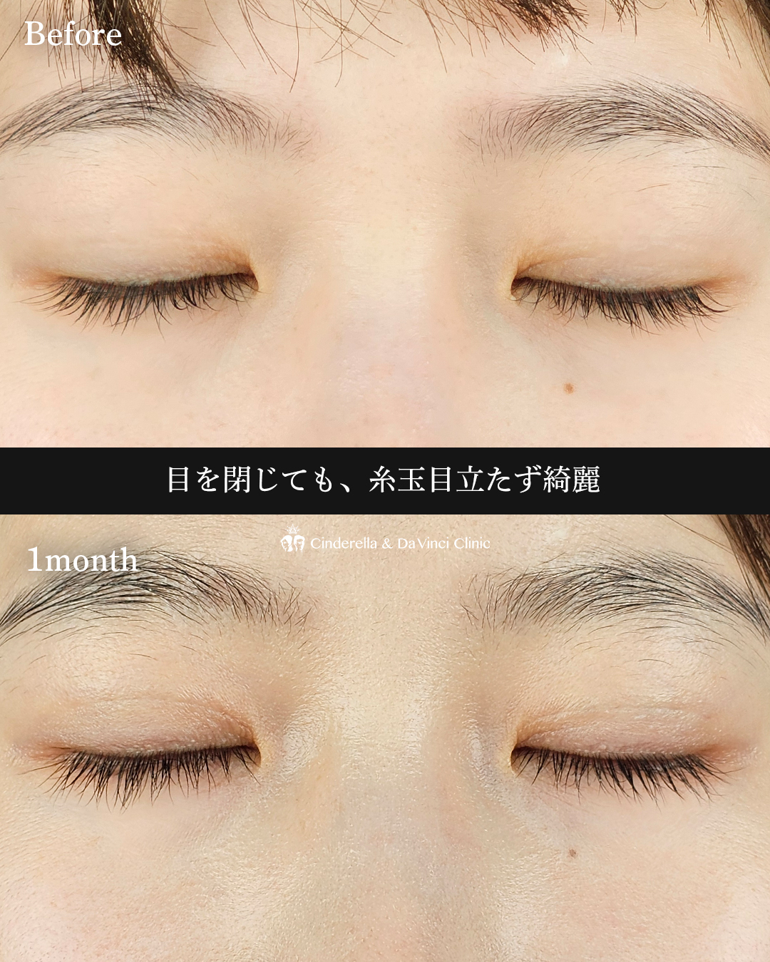 ナチュ盛り二重の画像