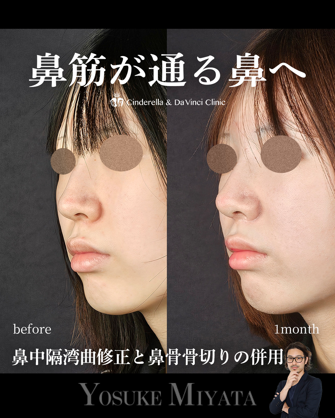鼻筋が通る鼻への画像