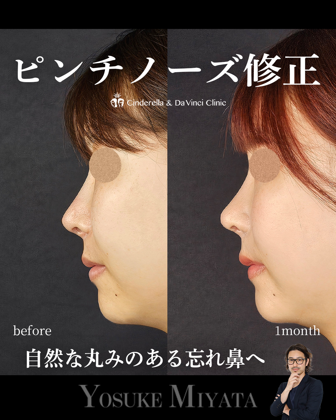 ピンチノーズ修正の画像