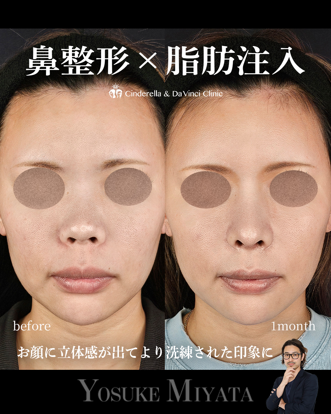 鼻整形×脂肪注入の画像