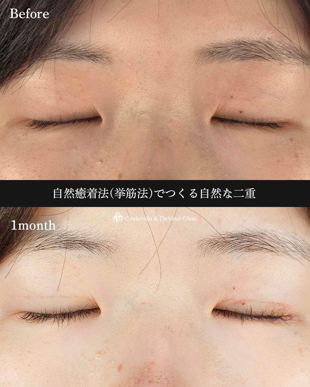 自然な二重の画像
