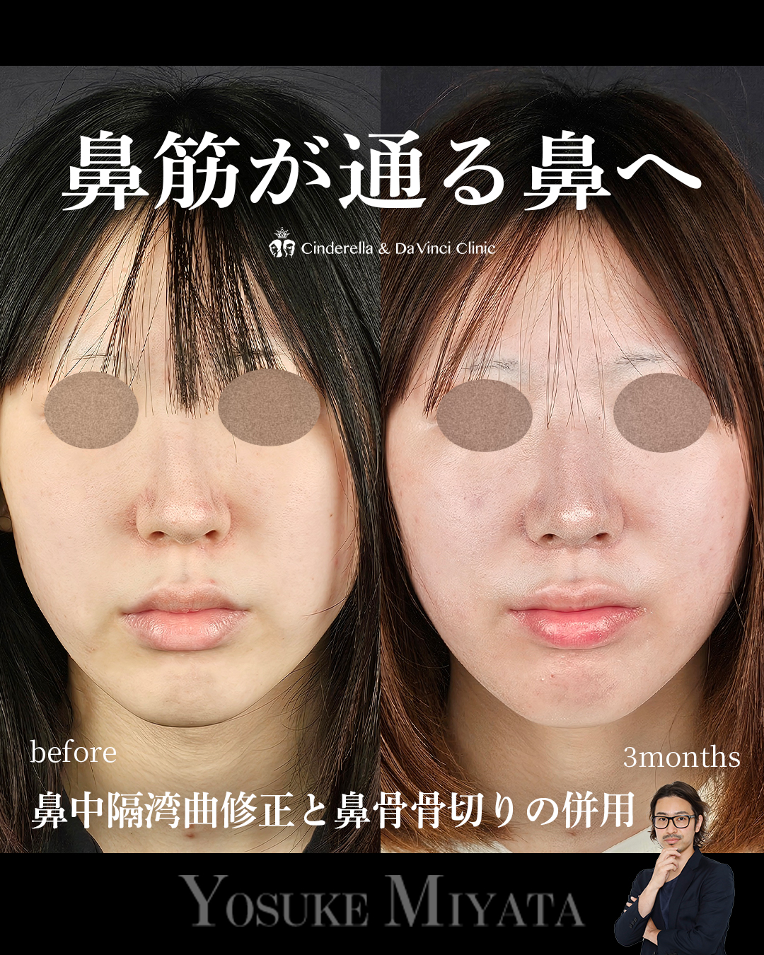 鼻筋が通る鼻への画像