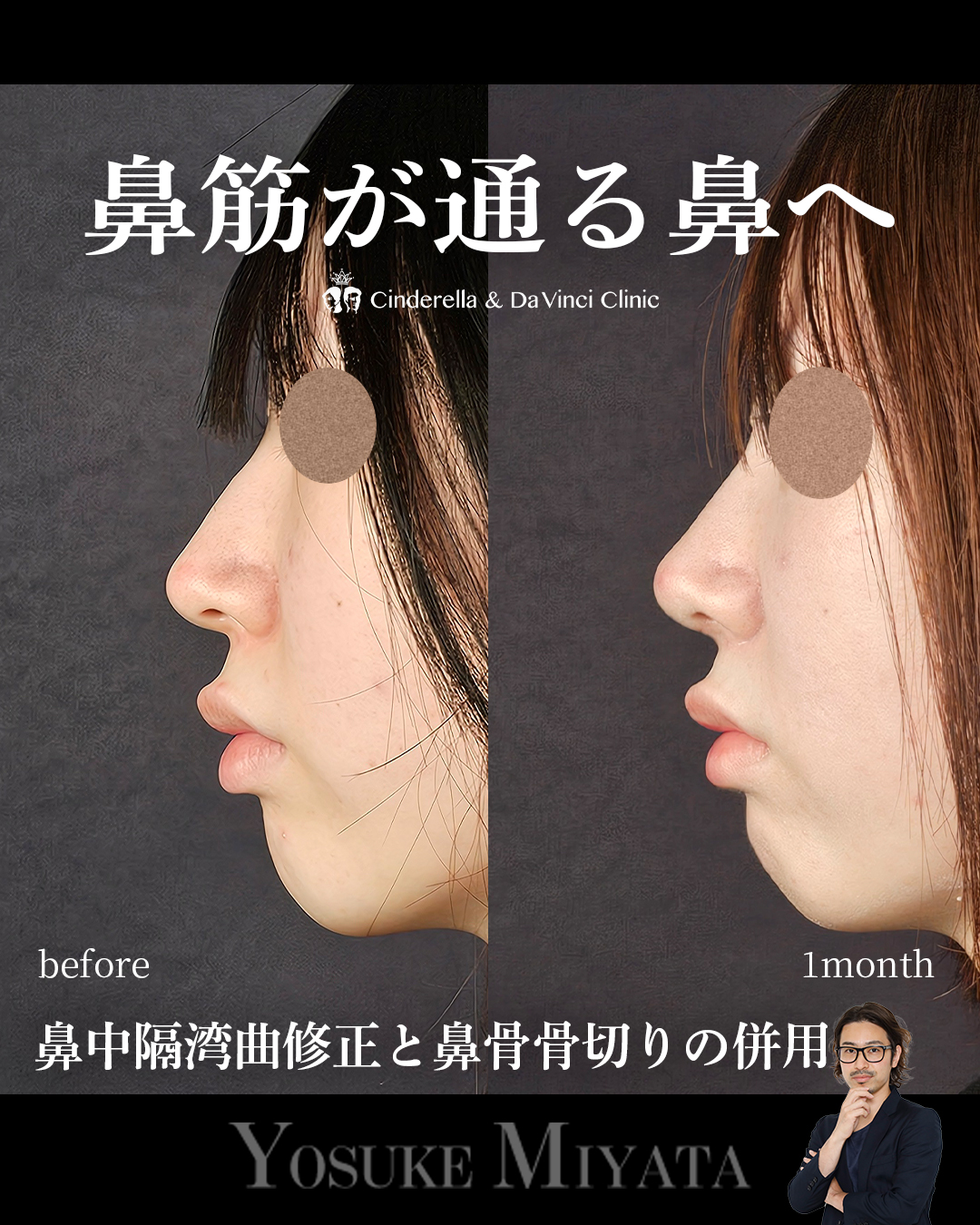 鼻筋が通る鼻への画像