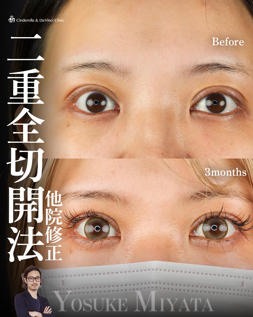 自然で華やかな二重