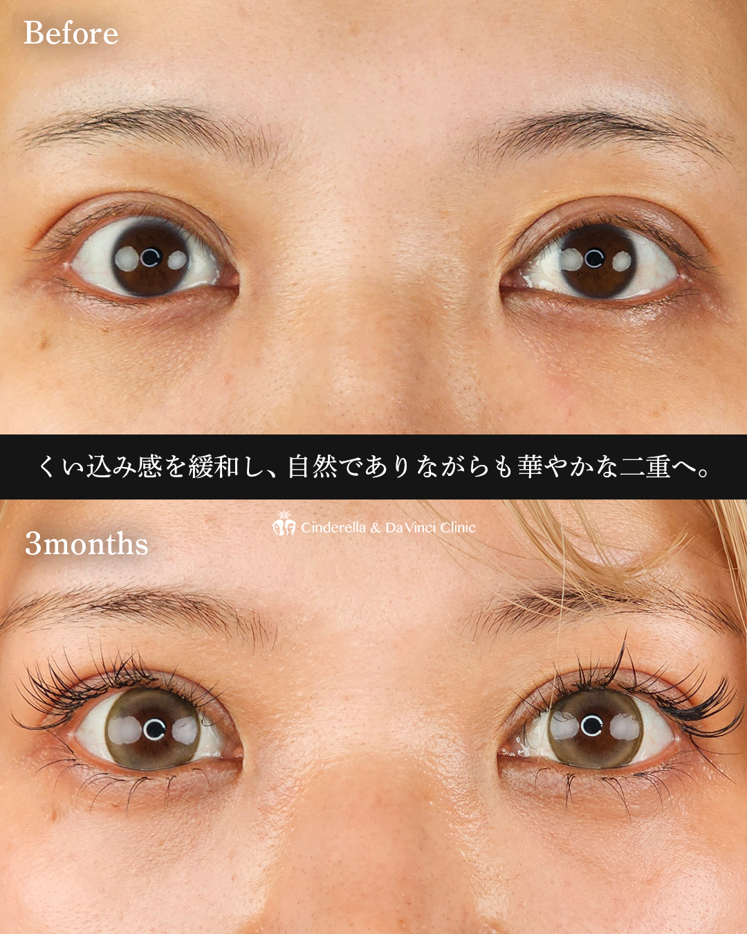 自然で華やかな二重の画像