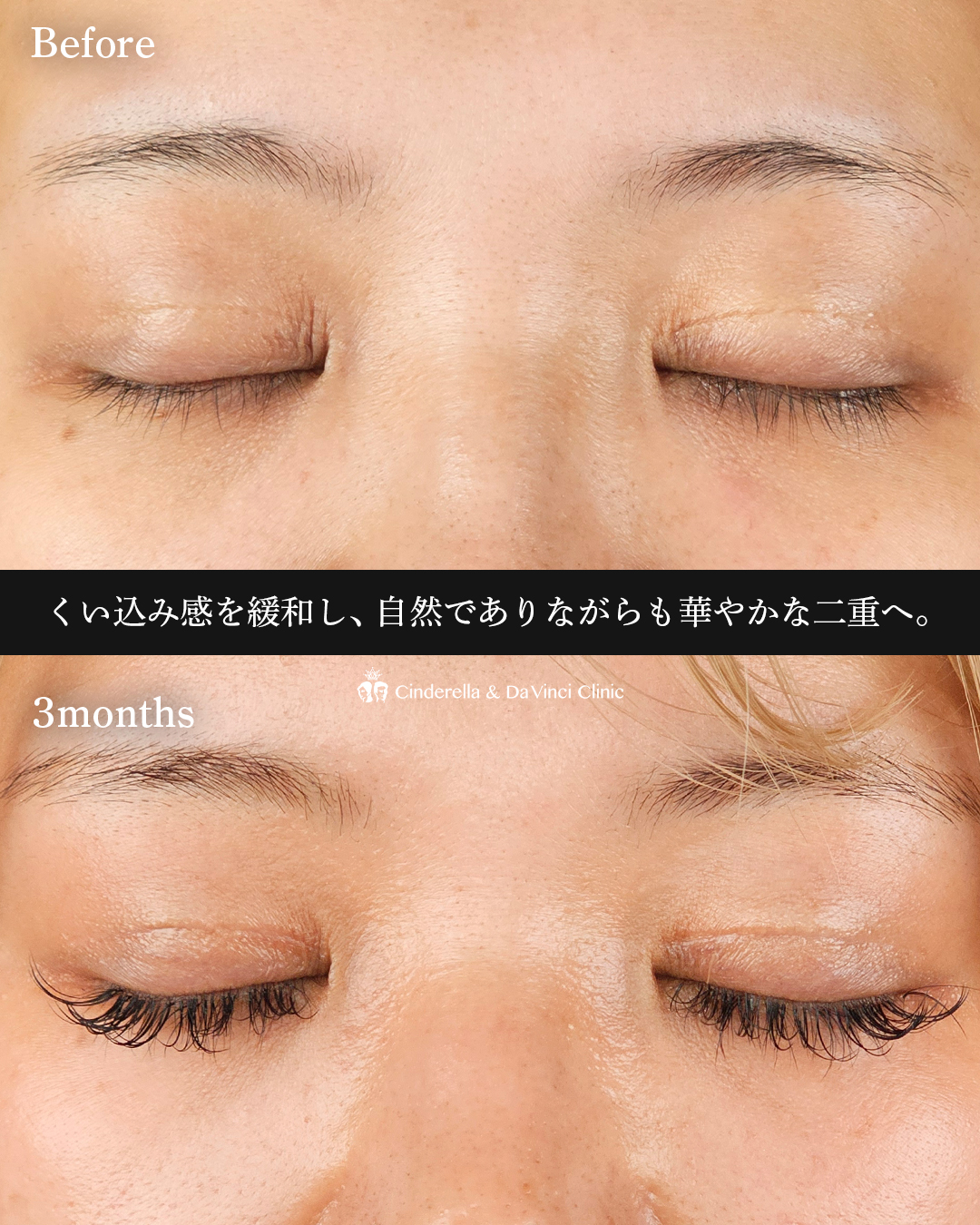 自然で華やかな二重の画像