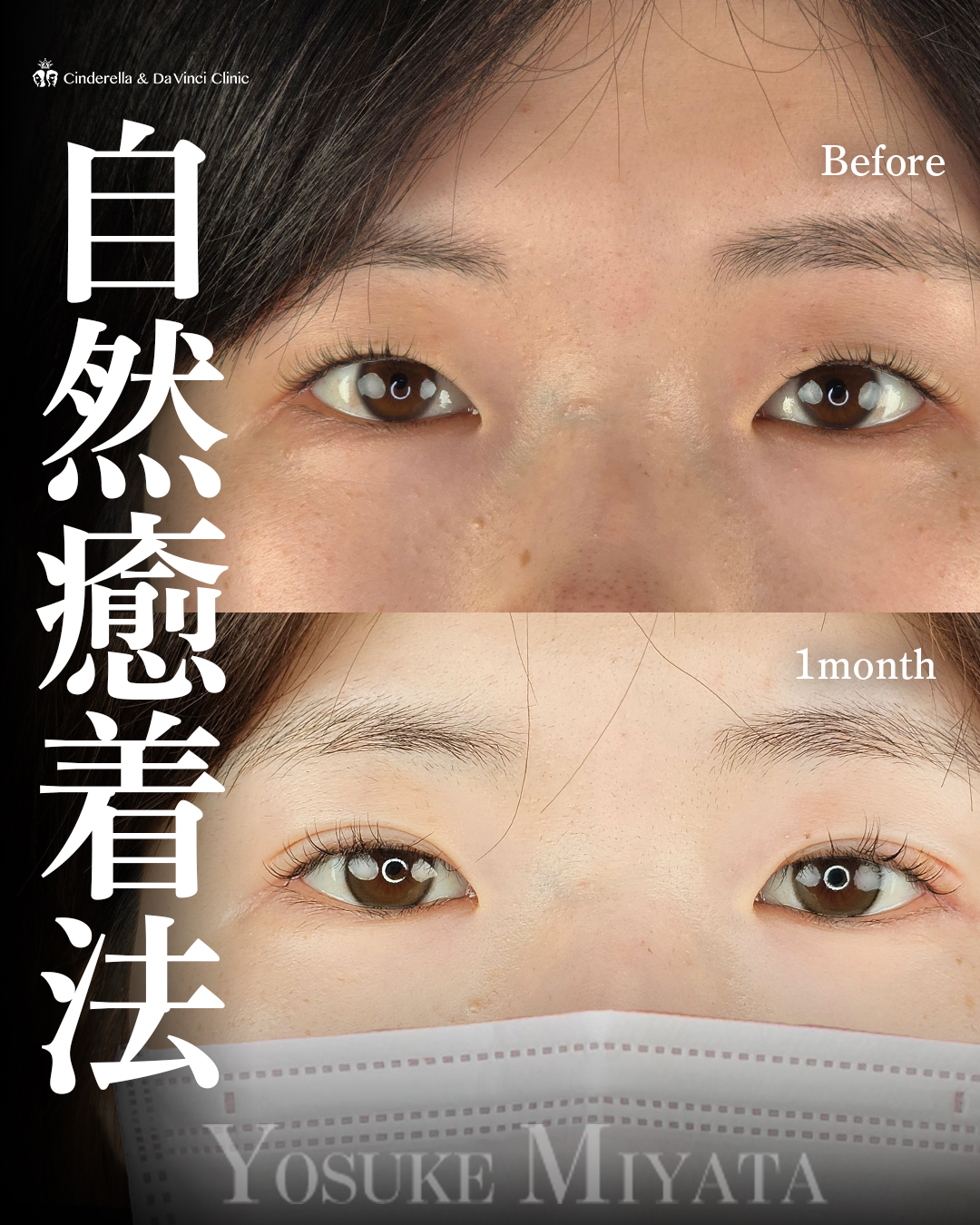 自然な二重