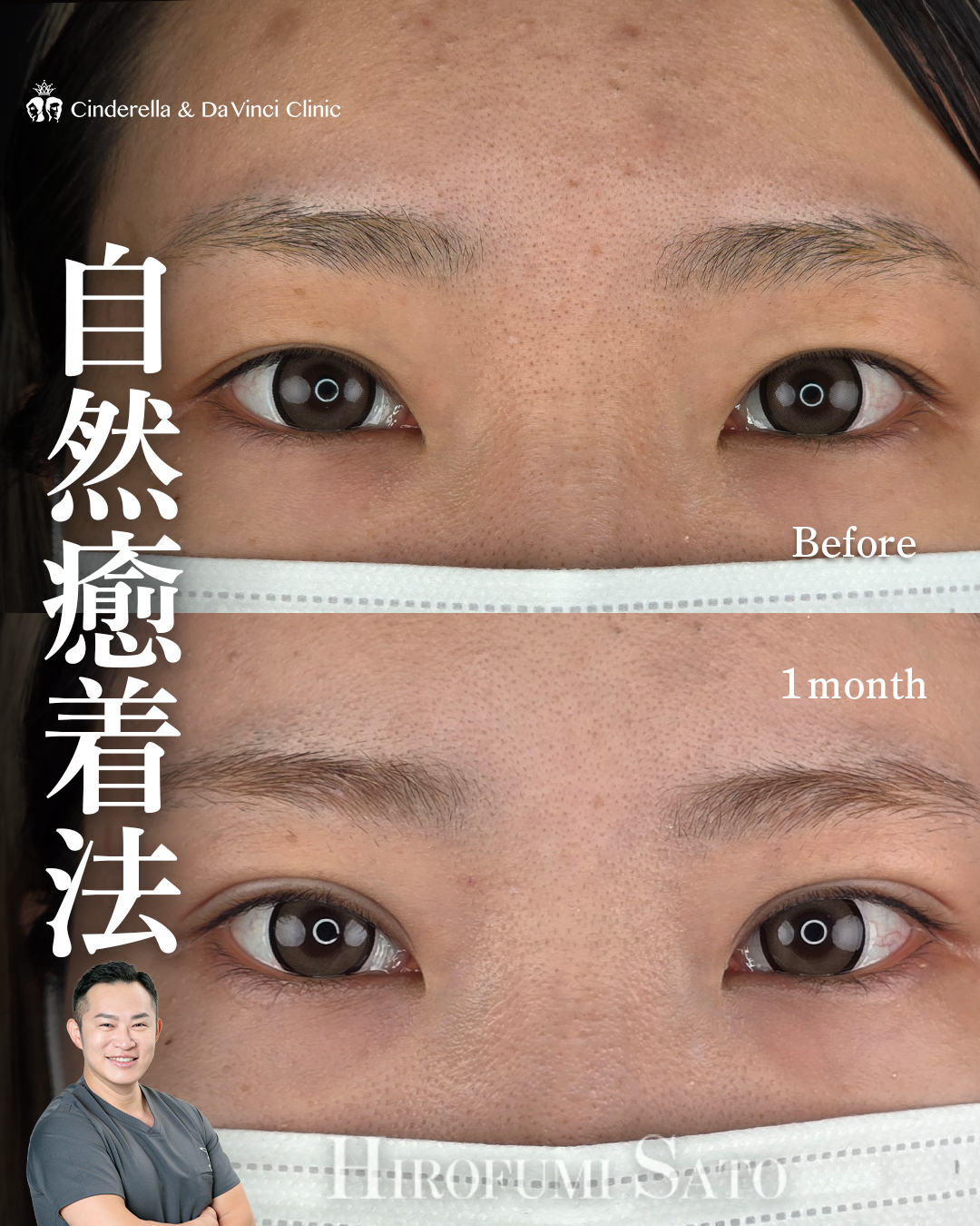 自然癒着法でミックス型二重
