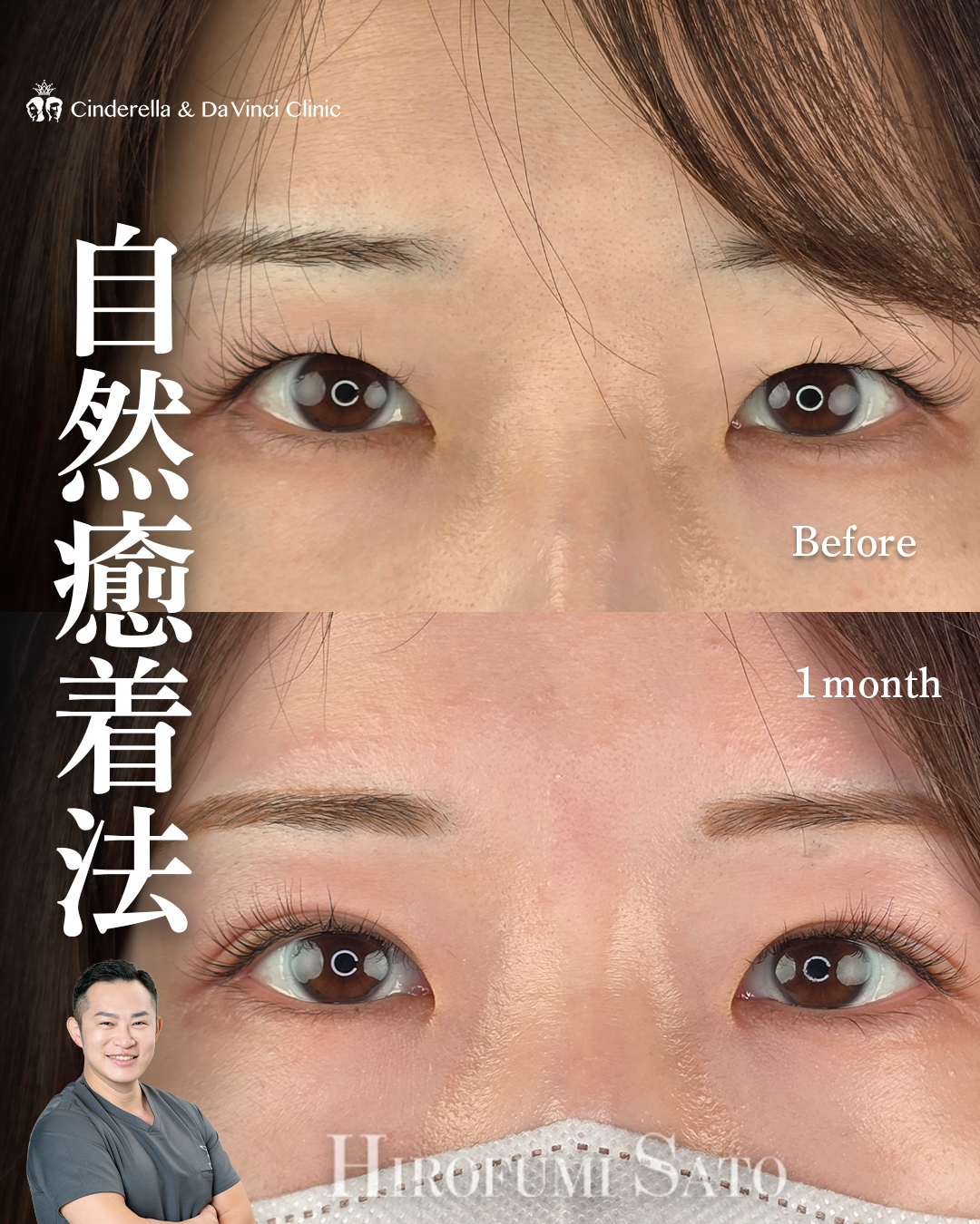 目を大きく見せる埋没