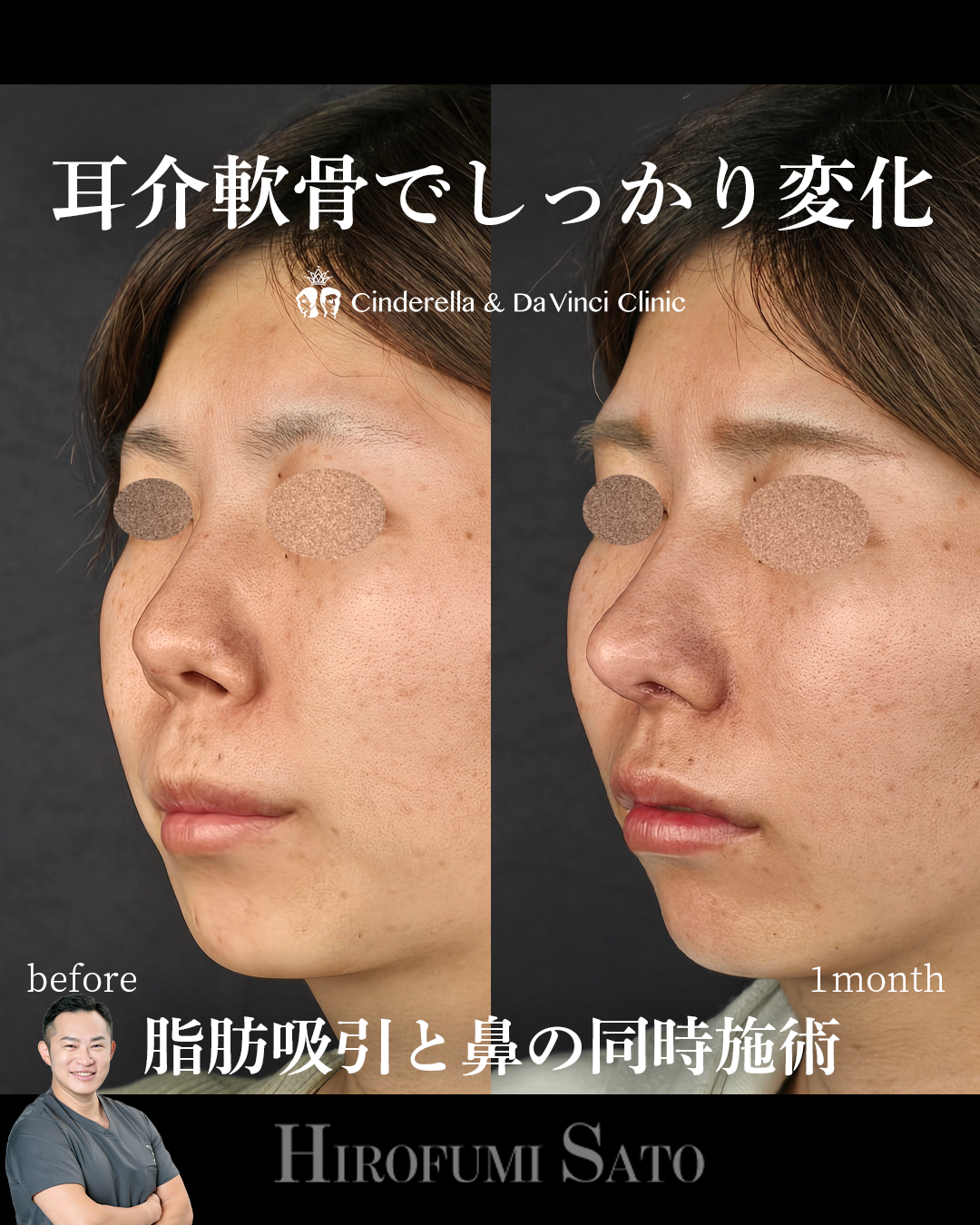 耳軟骨だけでしっかり変化