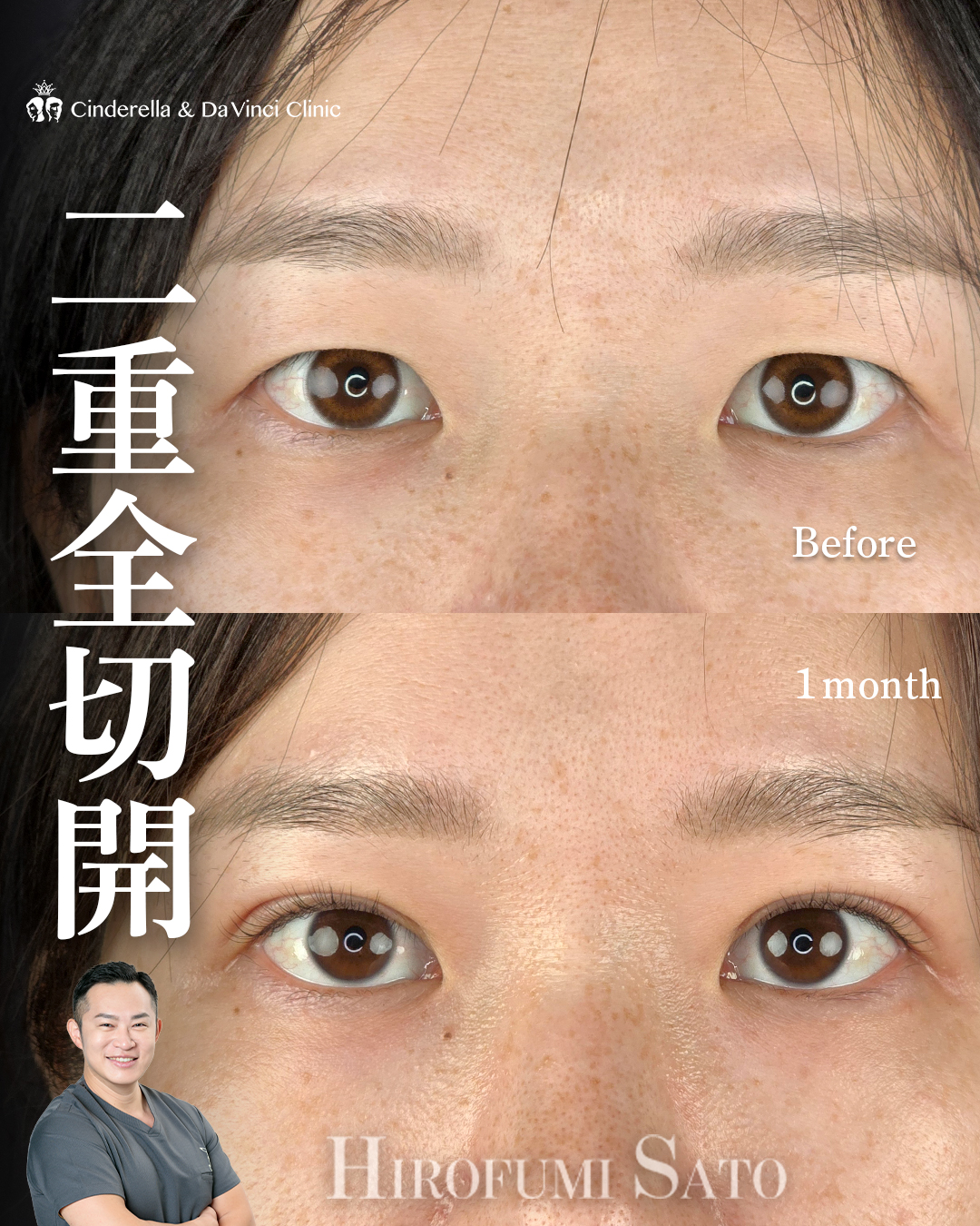 自然な仕上がりの二重切開