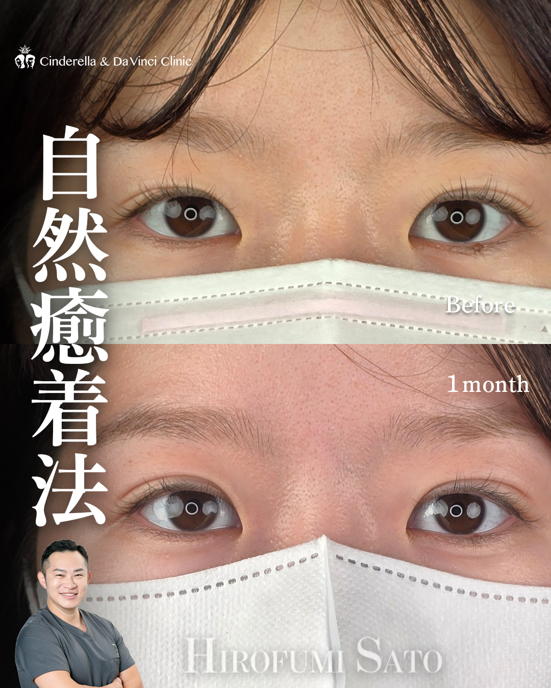 自然癒着法(瞼板法)