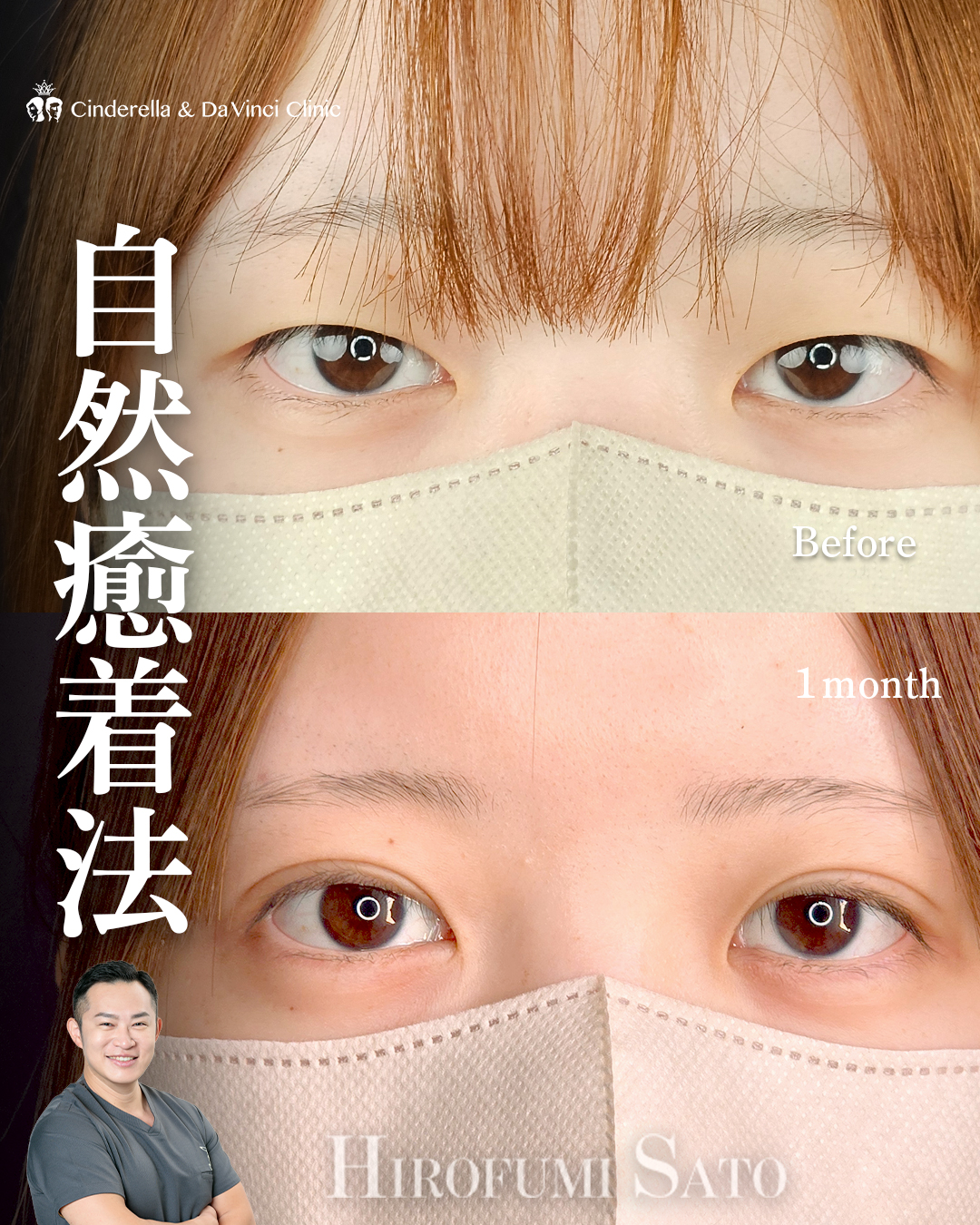 自然癒着法で二重に
