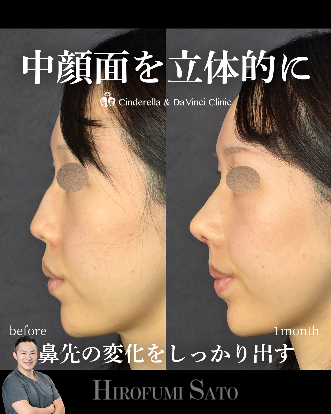鼻整形で中顔面の立体感を出す