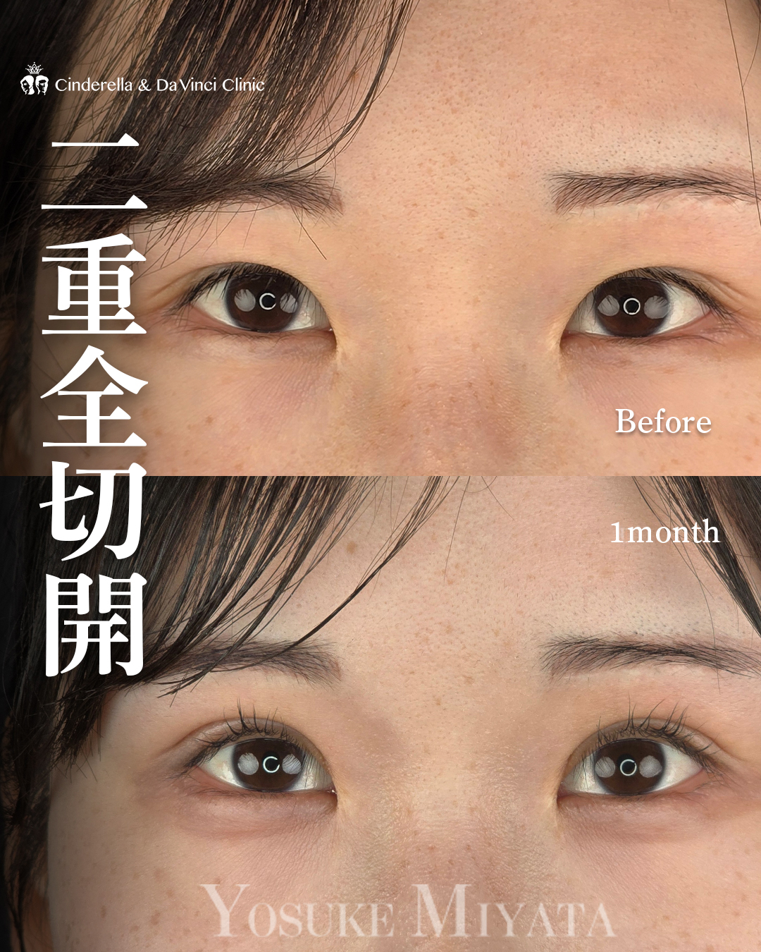 二重の切開法