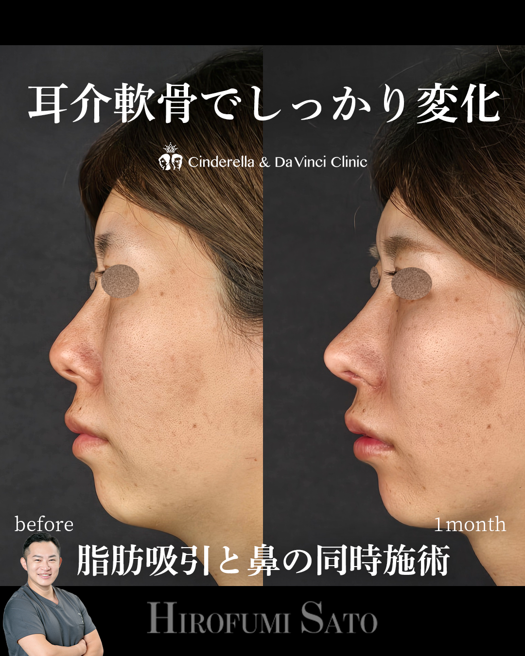 耳軟骨だけでしっかり変化の画像