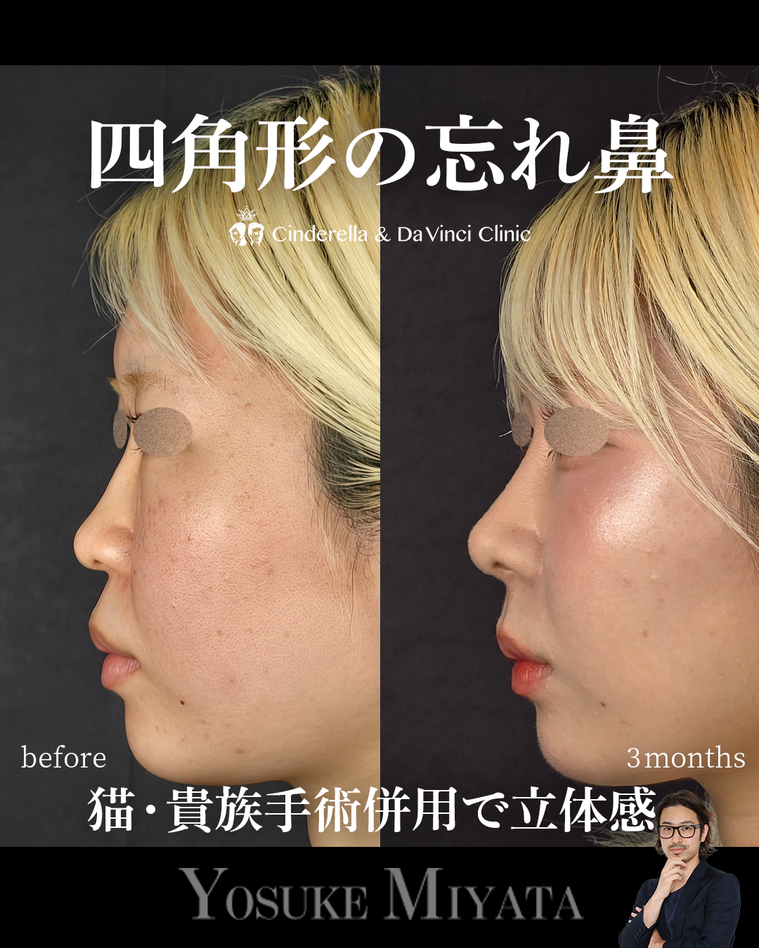 四角形の忘れ鼻