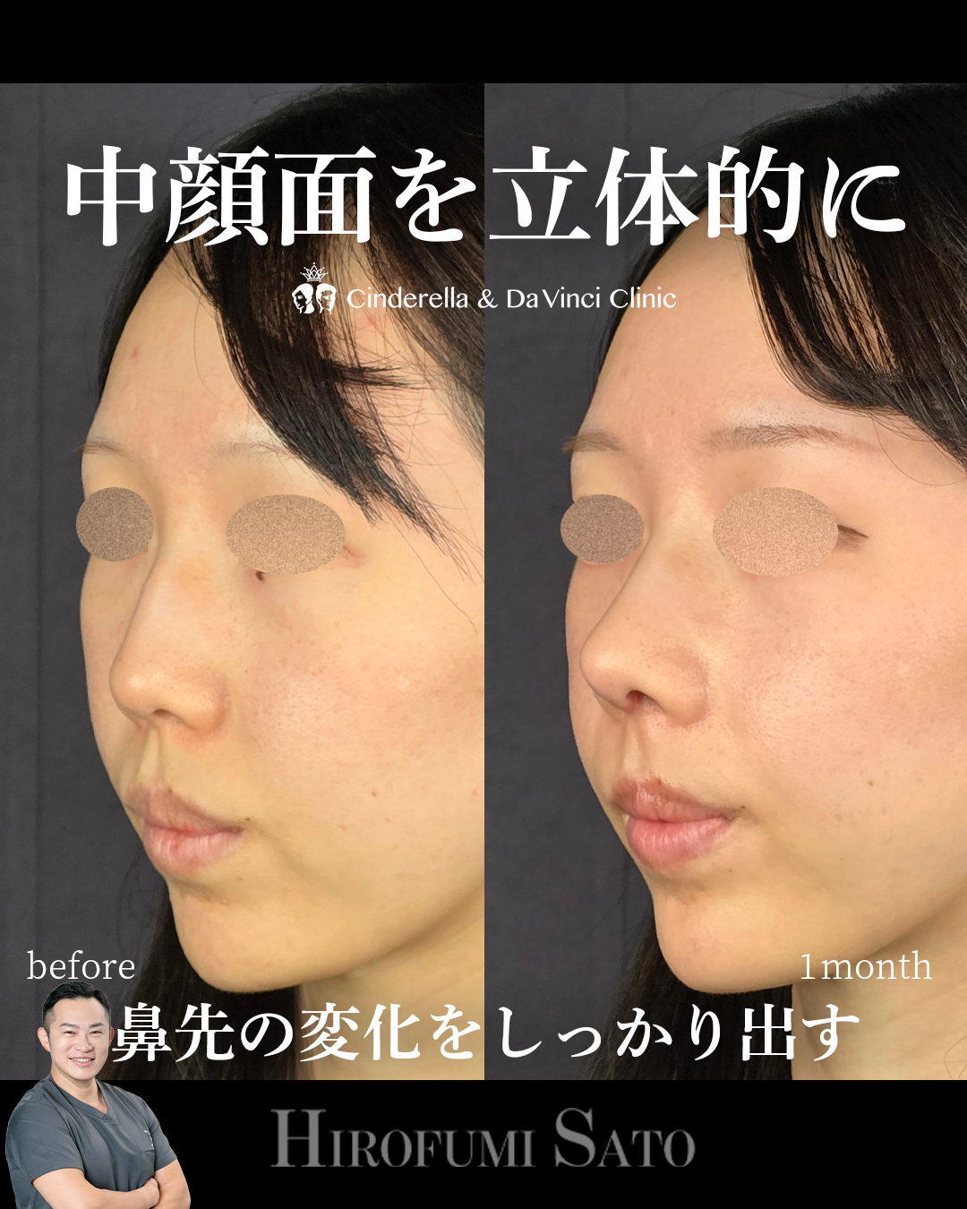 鼻整形で中顔面の立体感を出すの画像