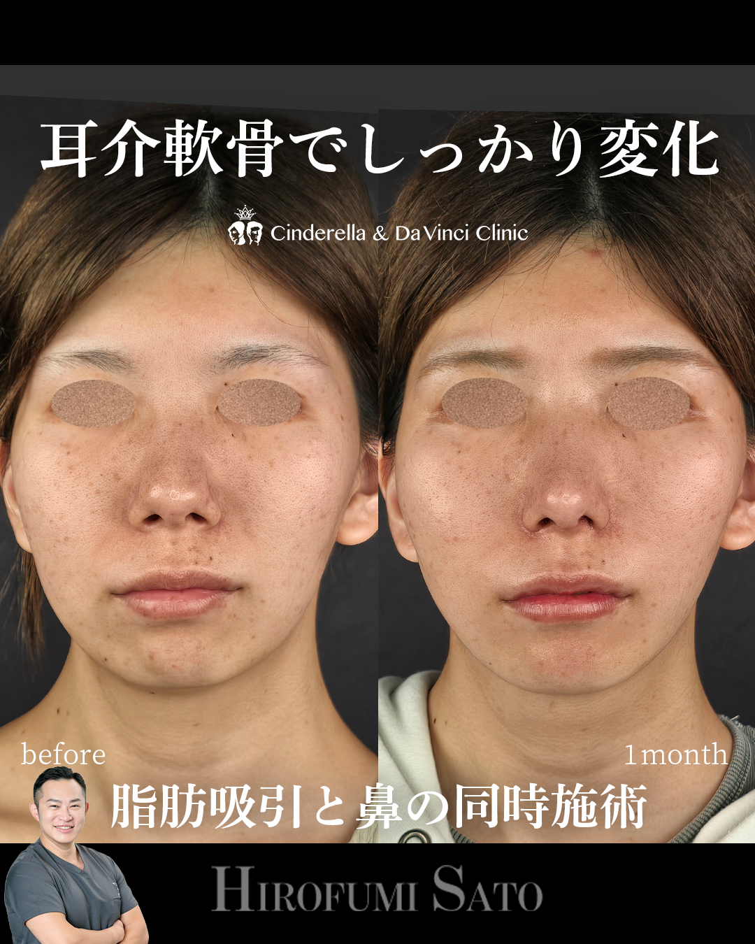 耳軟骨だけでしっかり変化の画像