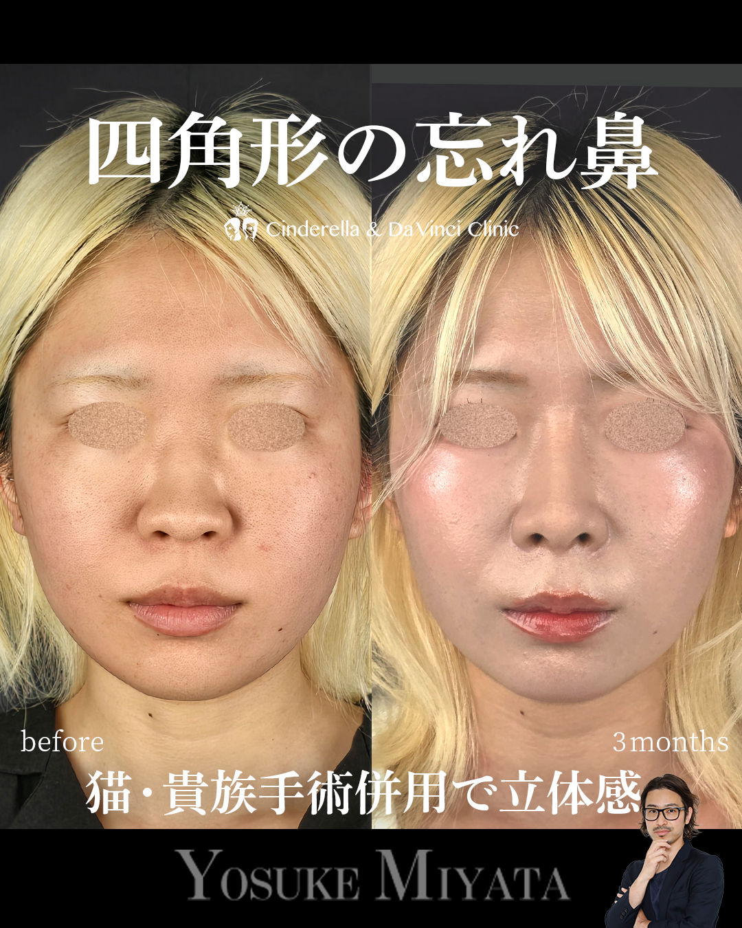 四角形の忘れ鼻の画像