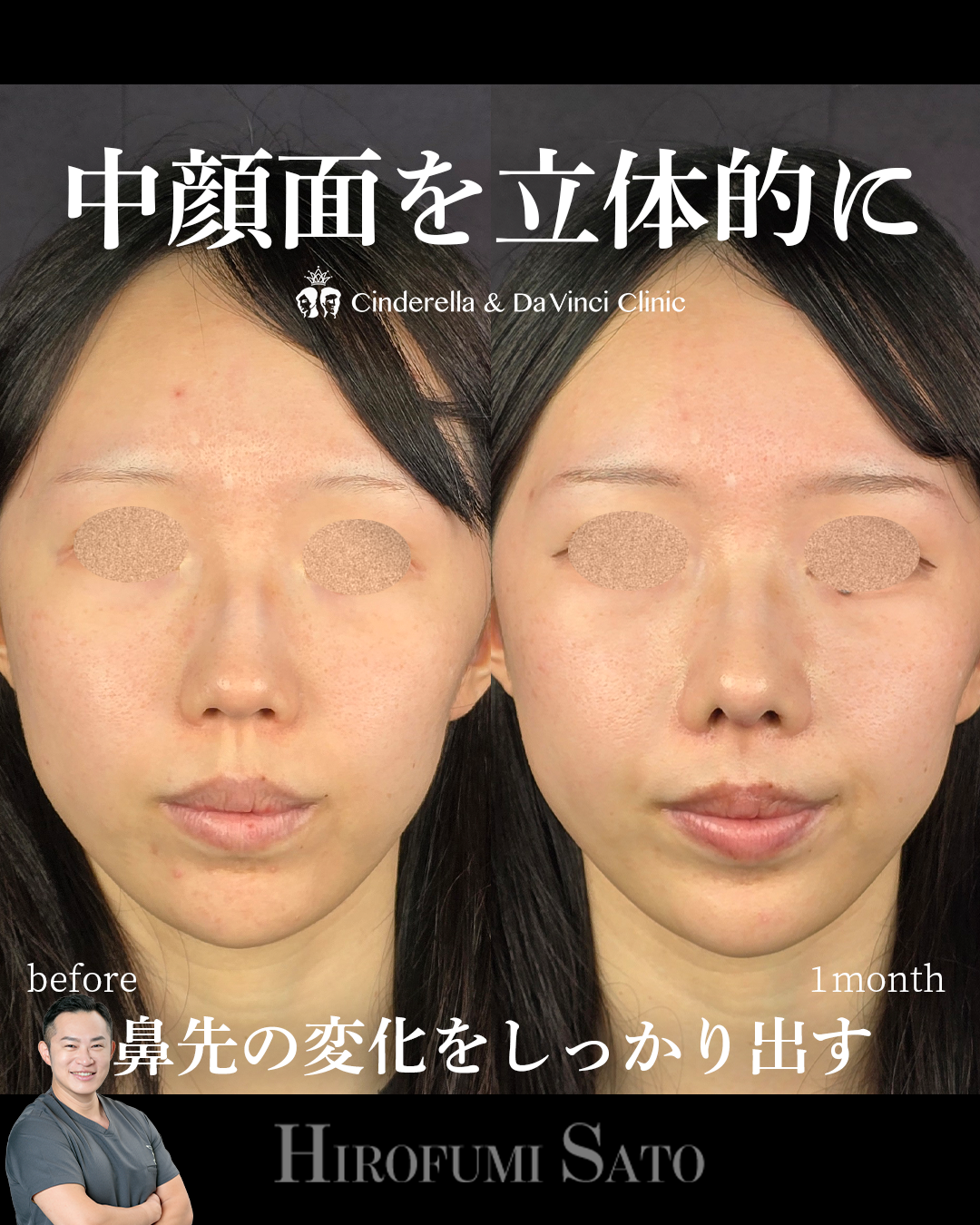 鼻整形で中顔面の立体感を出すの画像
