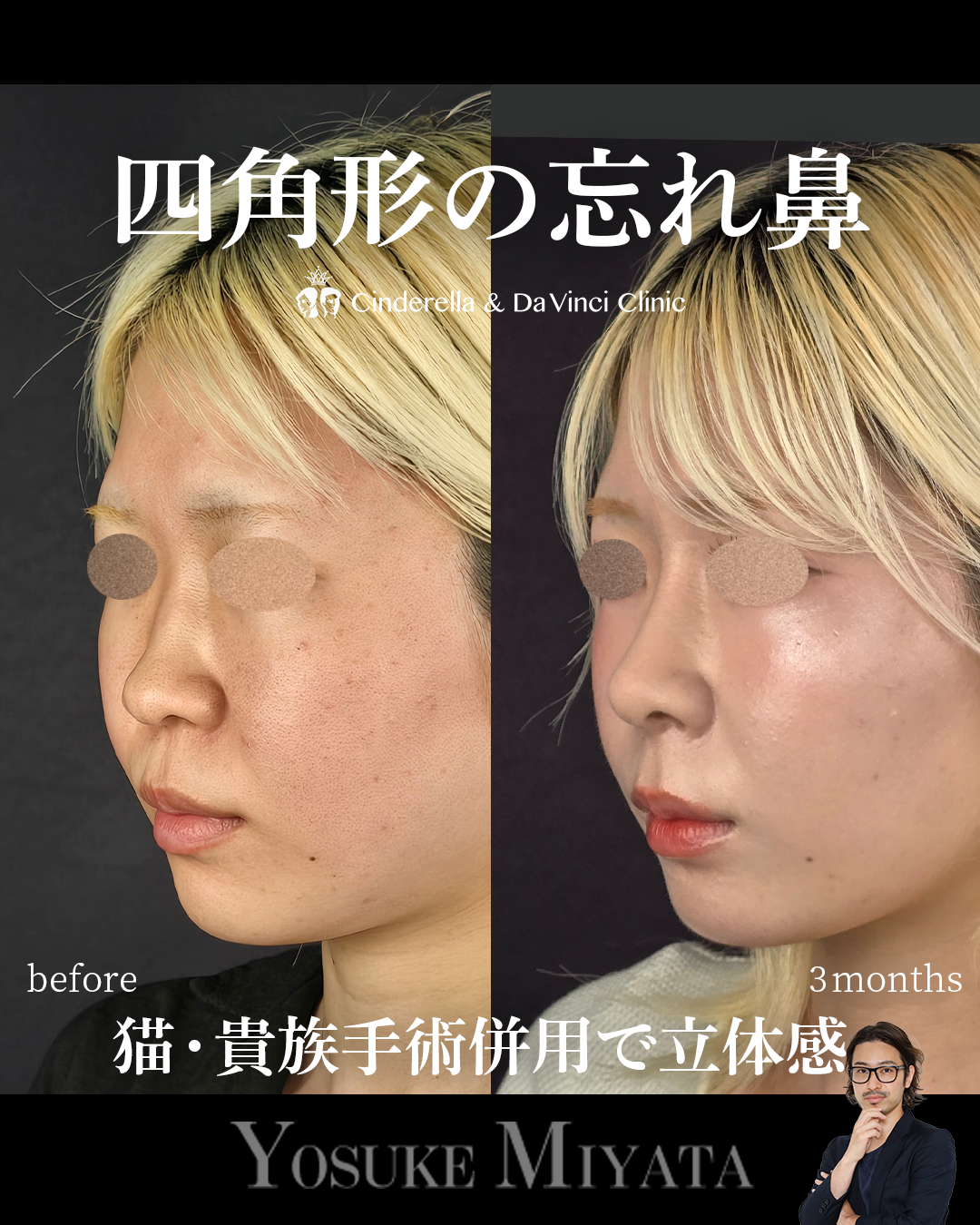 四角形の忘れ鼻の画像