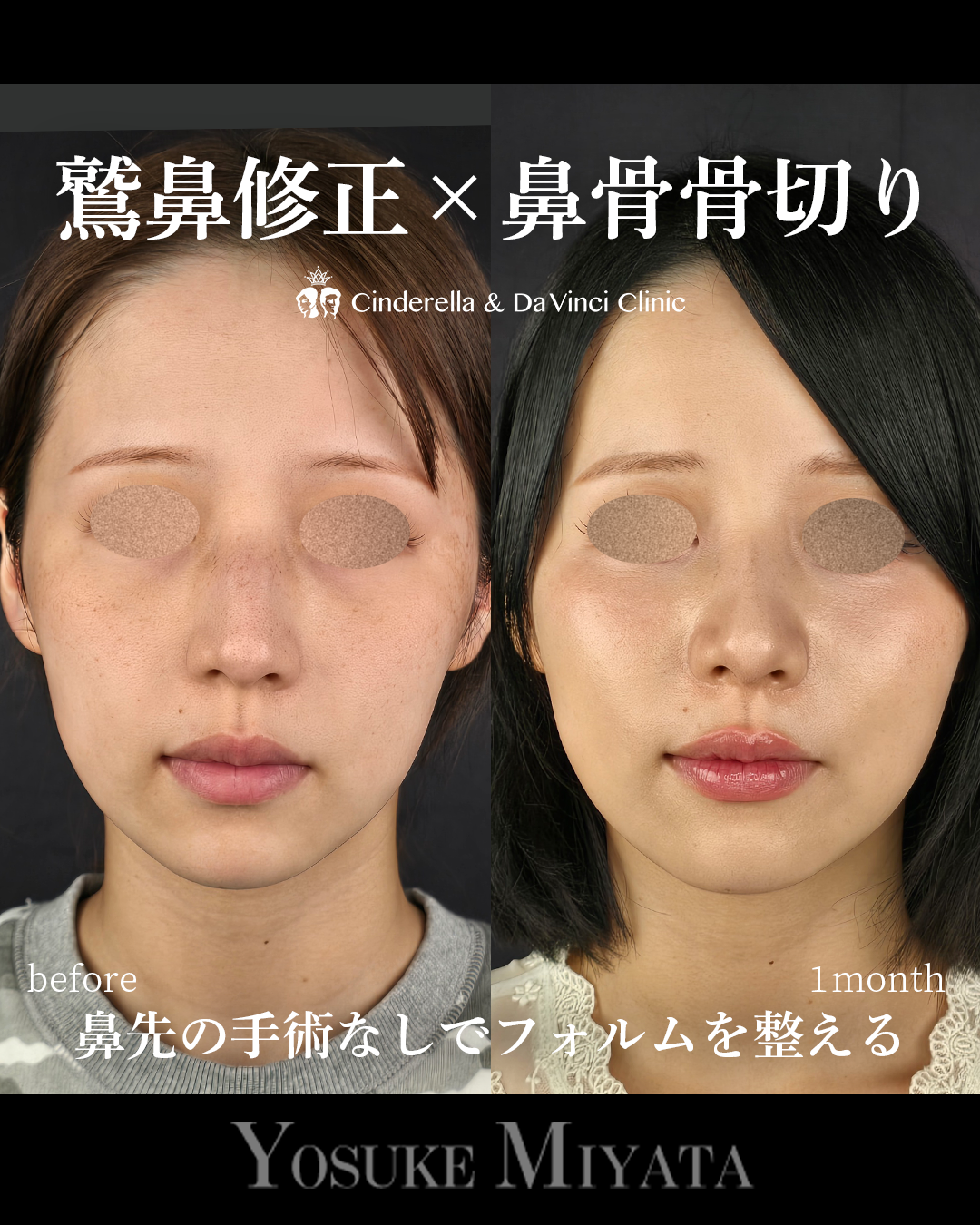 鷲鼻修正・鼻骨骨切りのみの画像