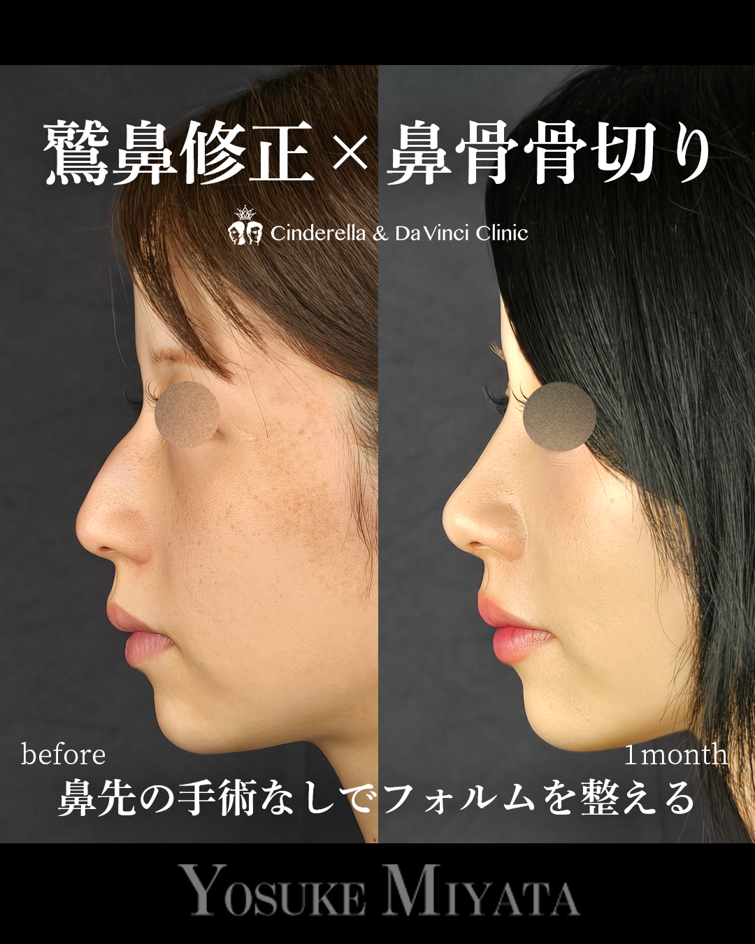 鷲鼻修正・鼻骨骨切りのみ