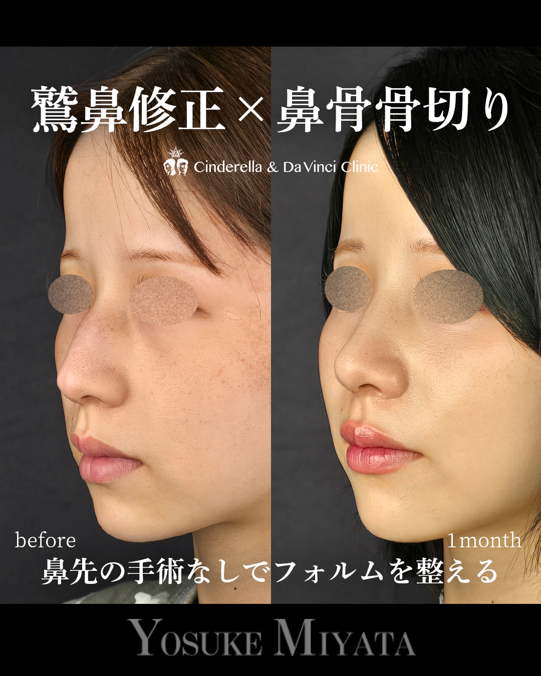 鷲鼻修正・鼻骨骨切りのみの画像