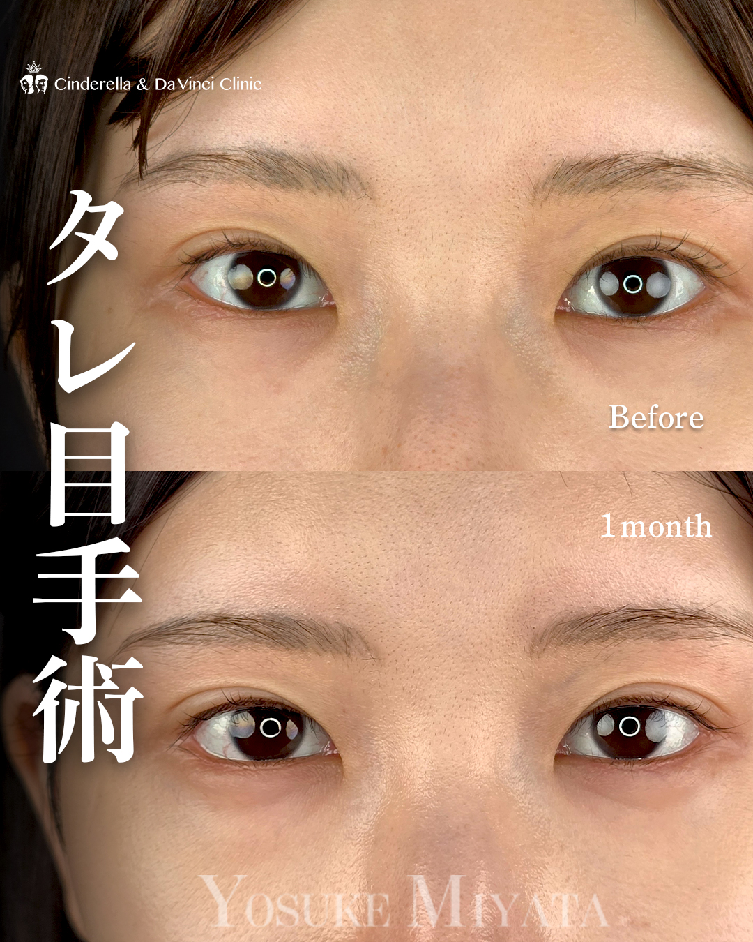 タレ目手術でツリ目を緩和