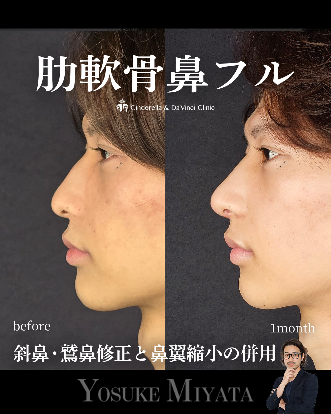 肋軟骨鼻フル